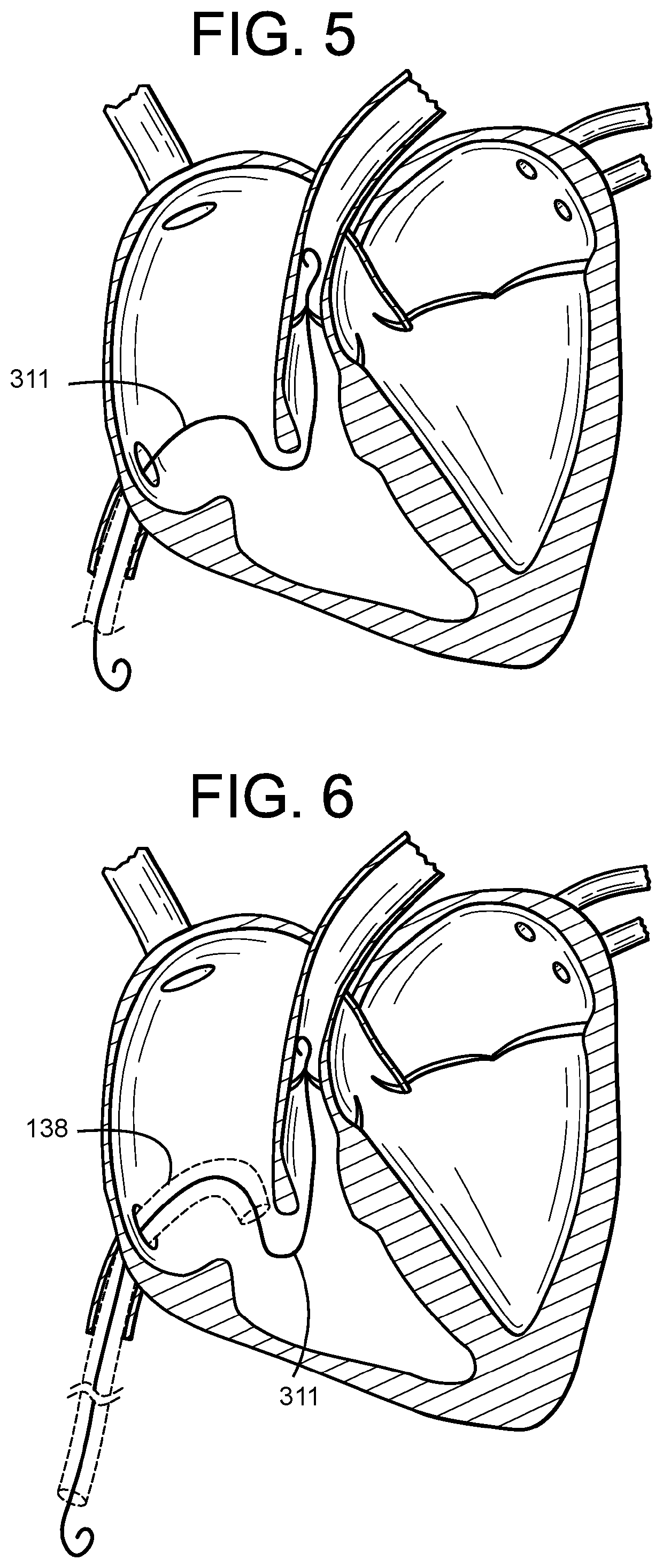 Guidewire Delivery of Transcatheter Heart Valve