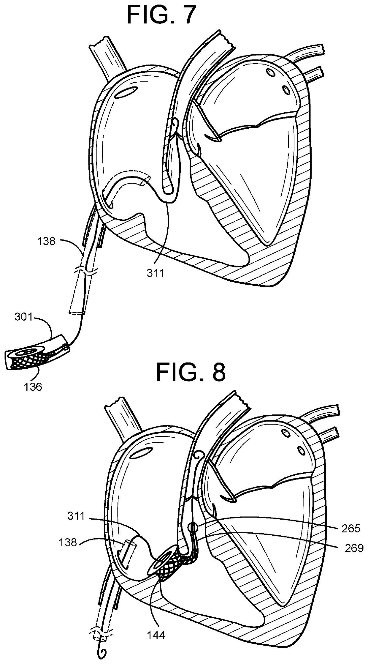 Guidewire Delivery of Transcatheter Heart Valve