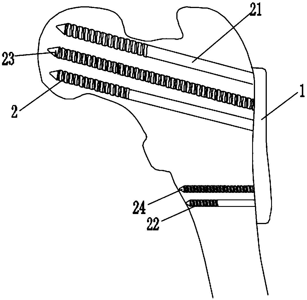 Universal locking device of femoral neck and femoral neck operation method