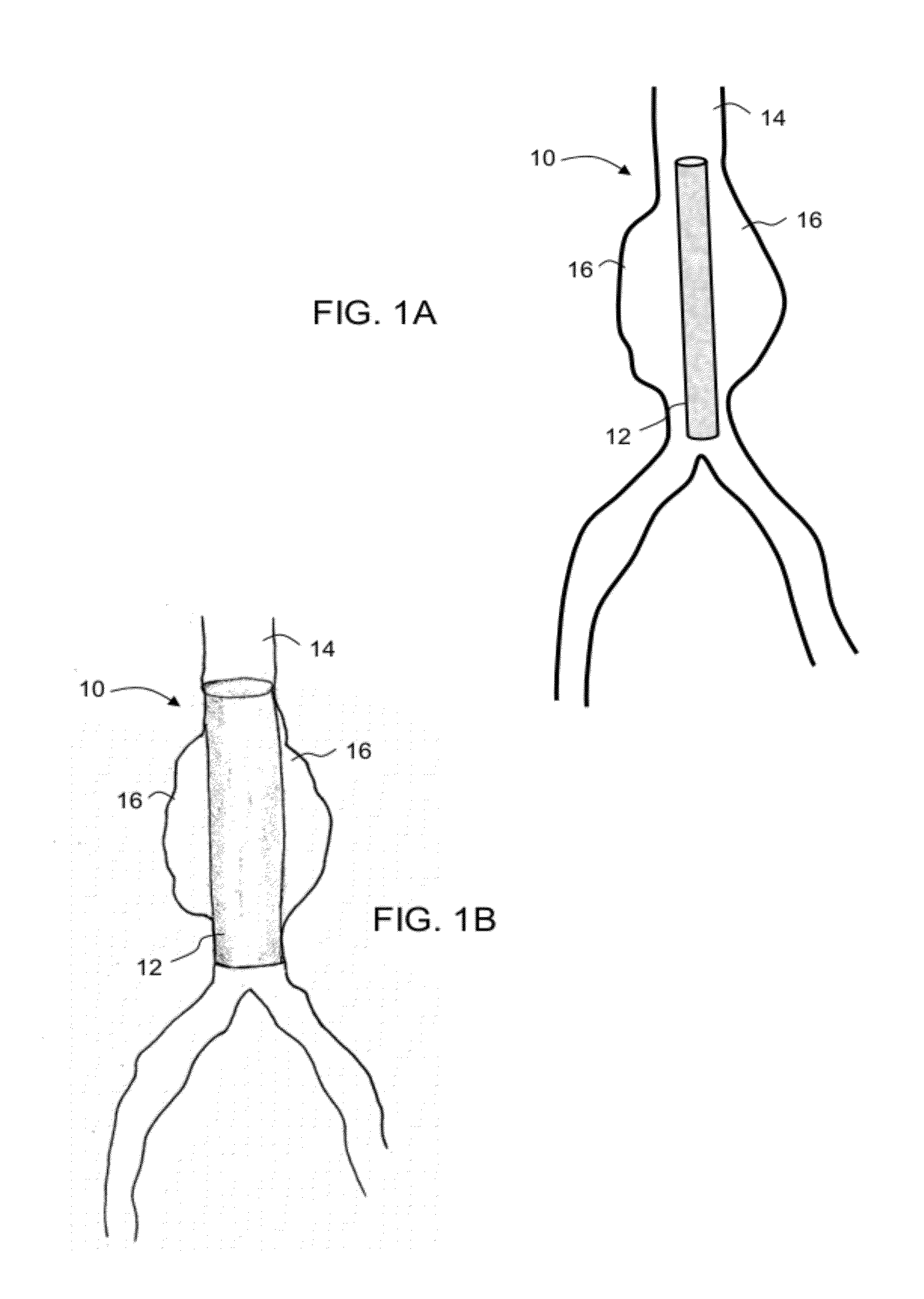 Intraluminal polymeric devices for the treatment of aneurysms