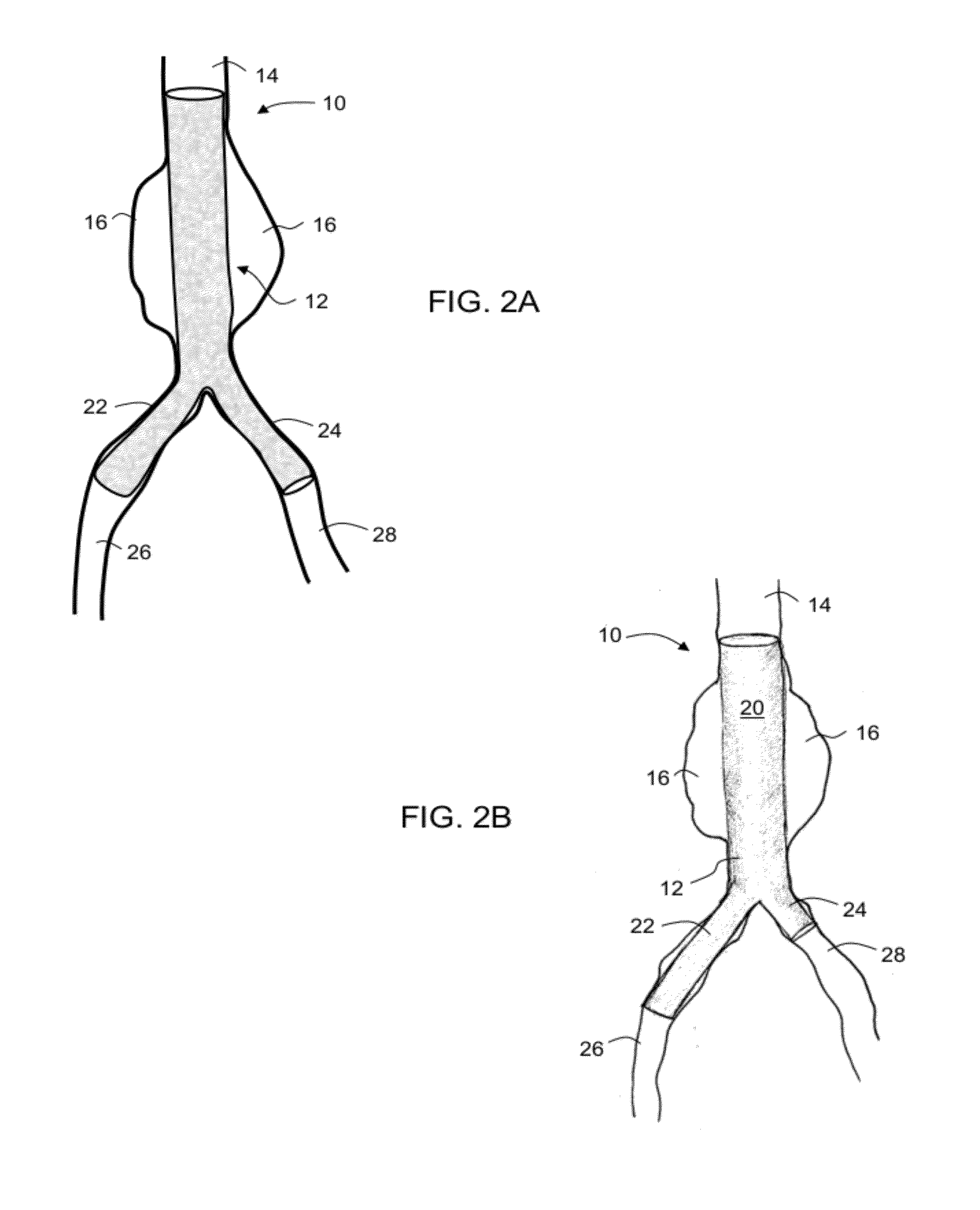 Intraluminal polymeric devices for the treatment of aneurysms