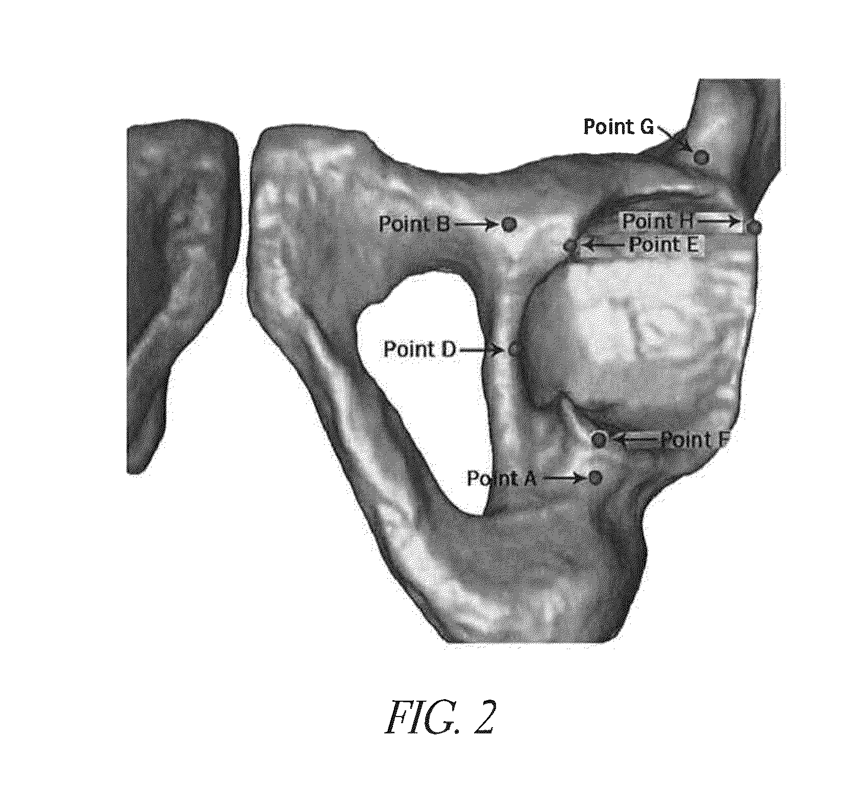 Hip replacement navigation system and method