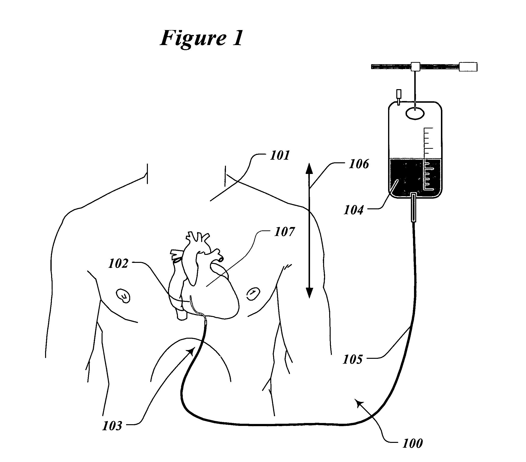 Method and system to treat and prevent myocardial infarct expansion