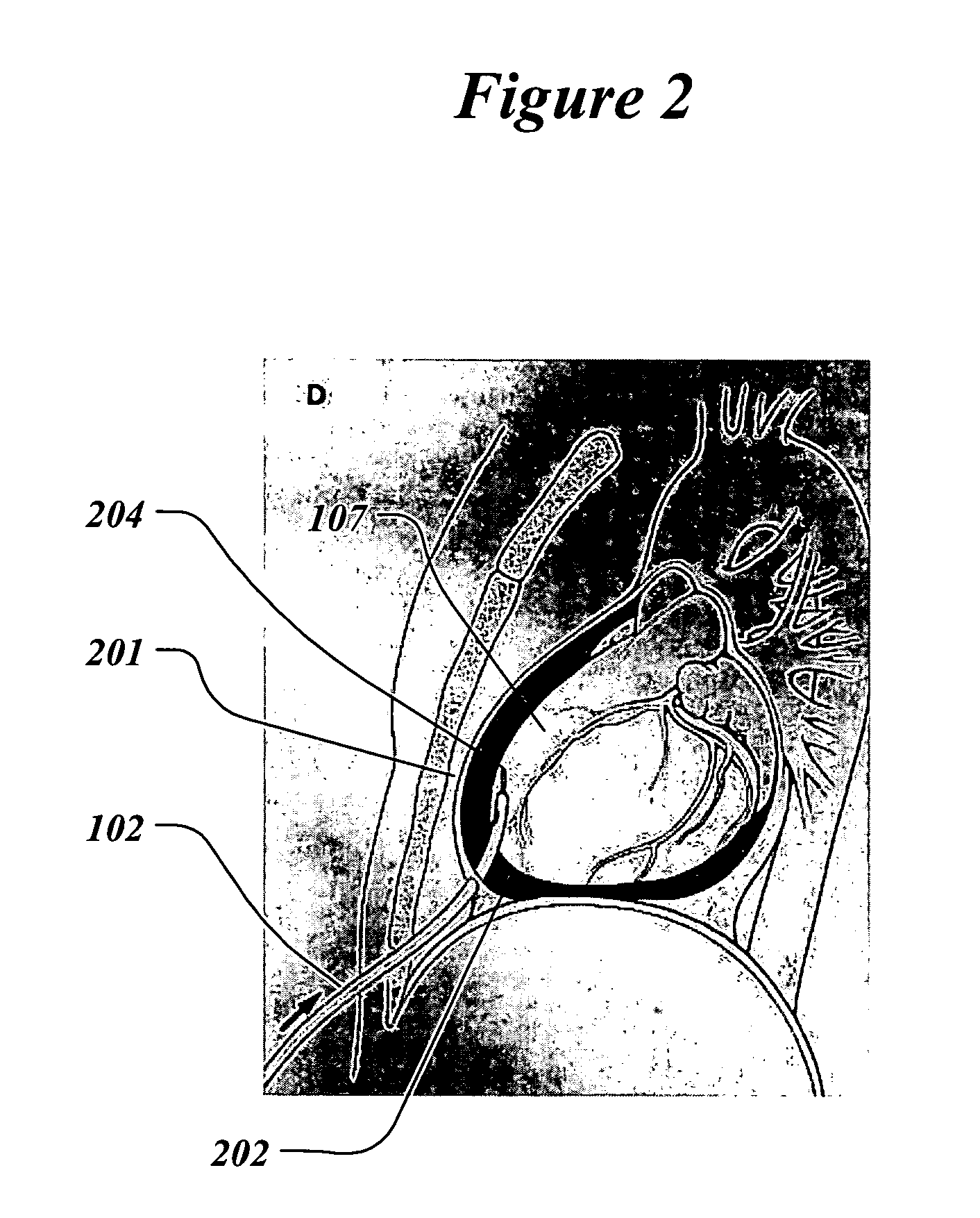 Method and system to treat and prevent myocardial infarct expansion