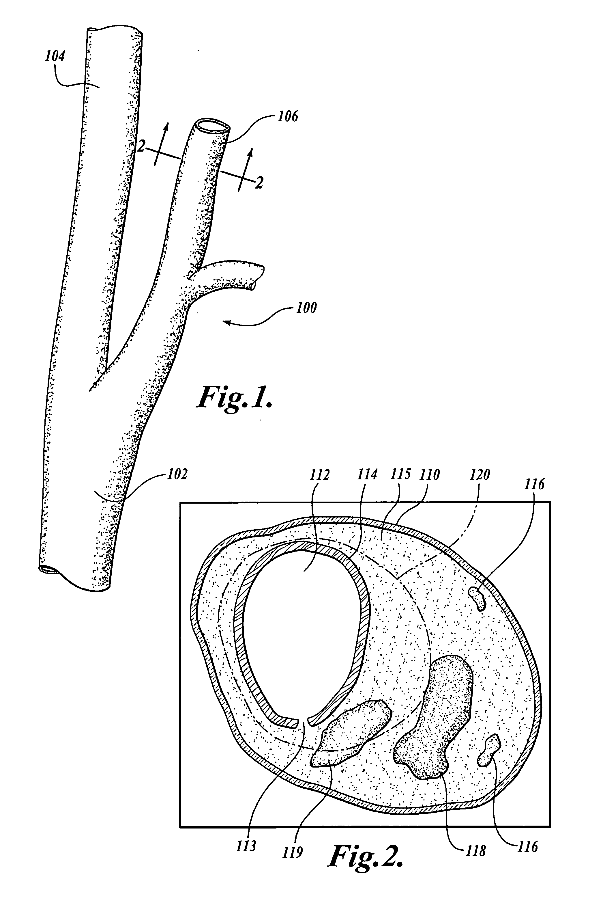 Method and system for atherosclerosis risk scoring