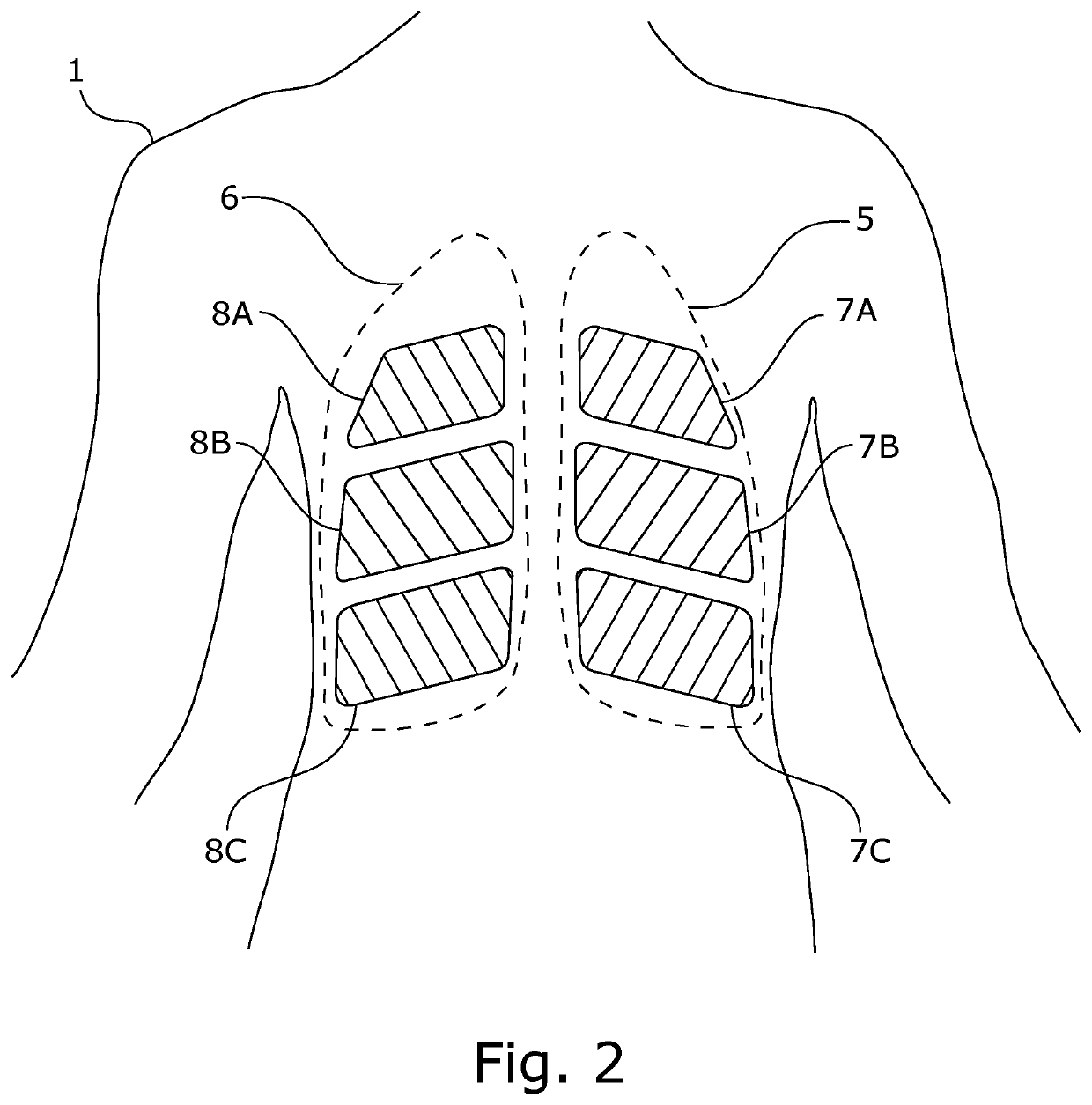 System for treating unwanted tissue using heat and heat activated drugs