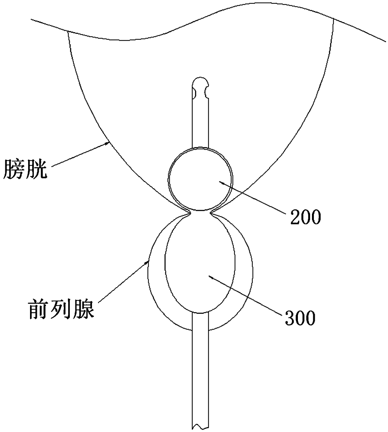 Internal and external double-capsule prostate hemostasis catheter