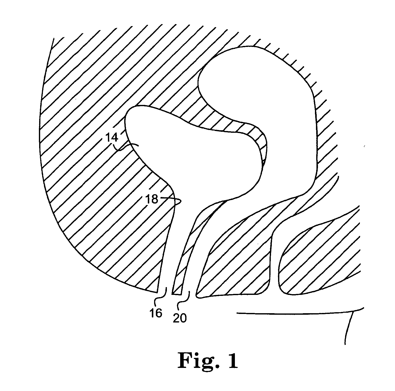 Method and articles for treatment of stress urinary incontinence