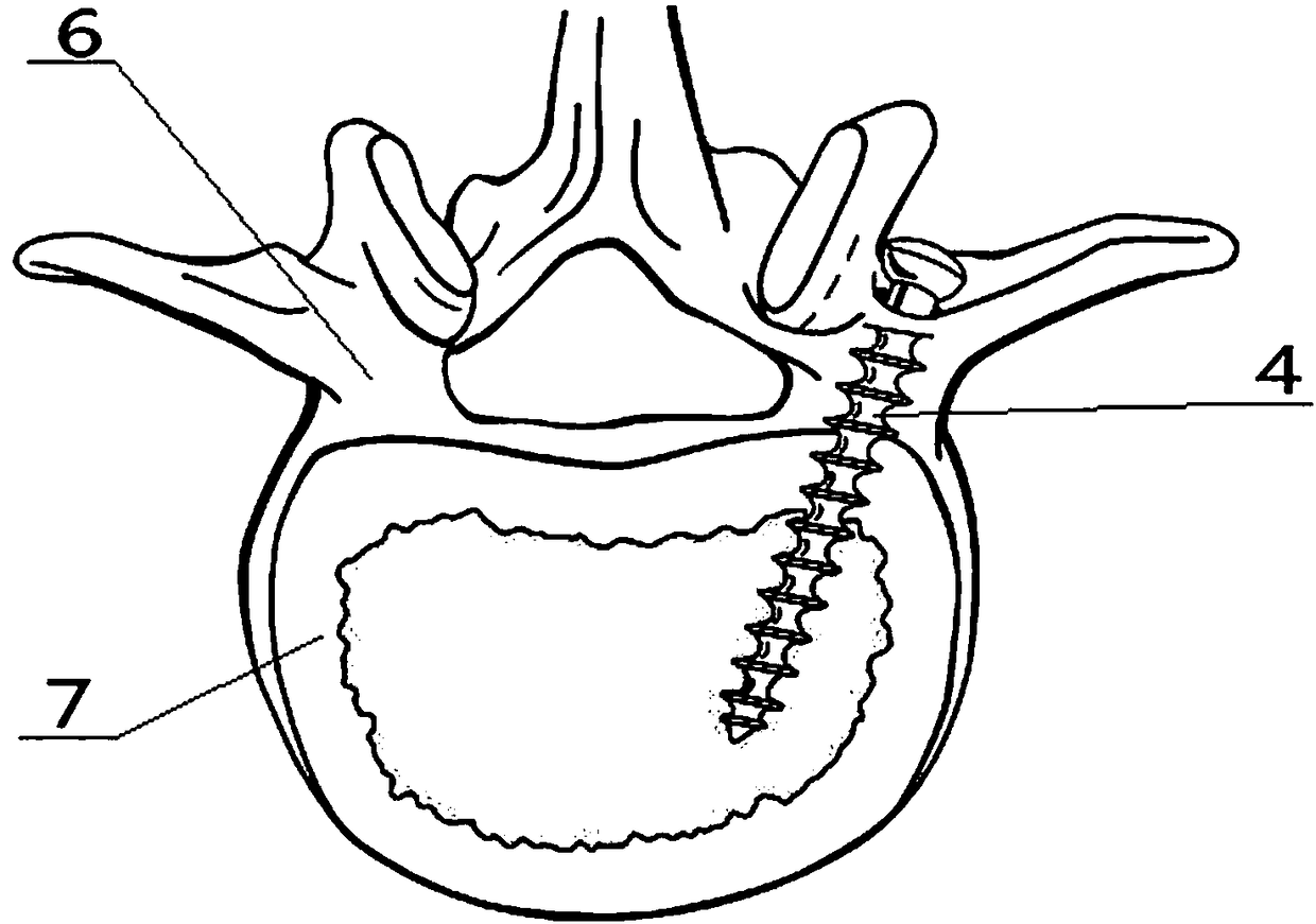 Spine vertebral pedicle set screw soft tissue protecting device