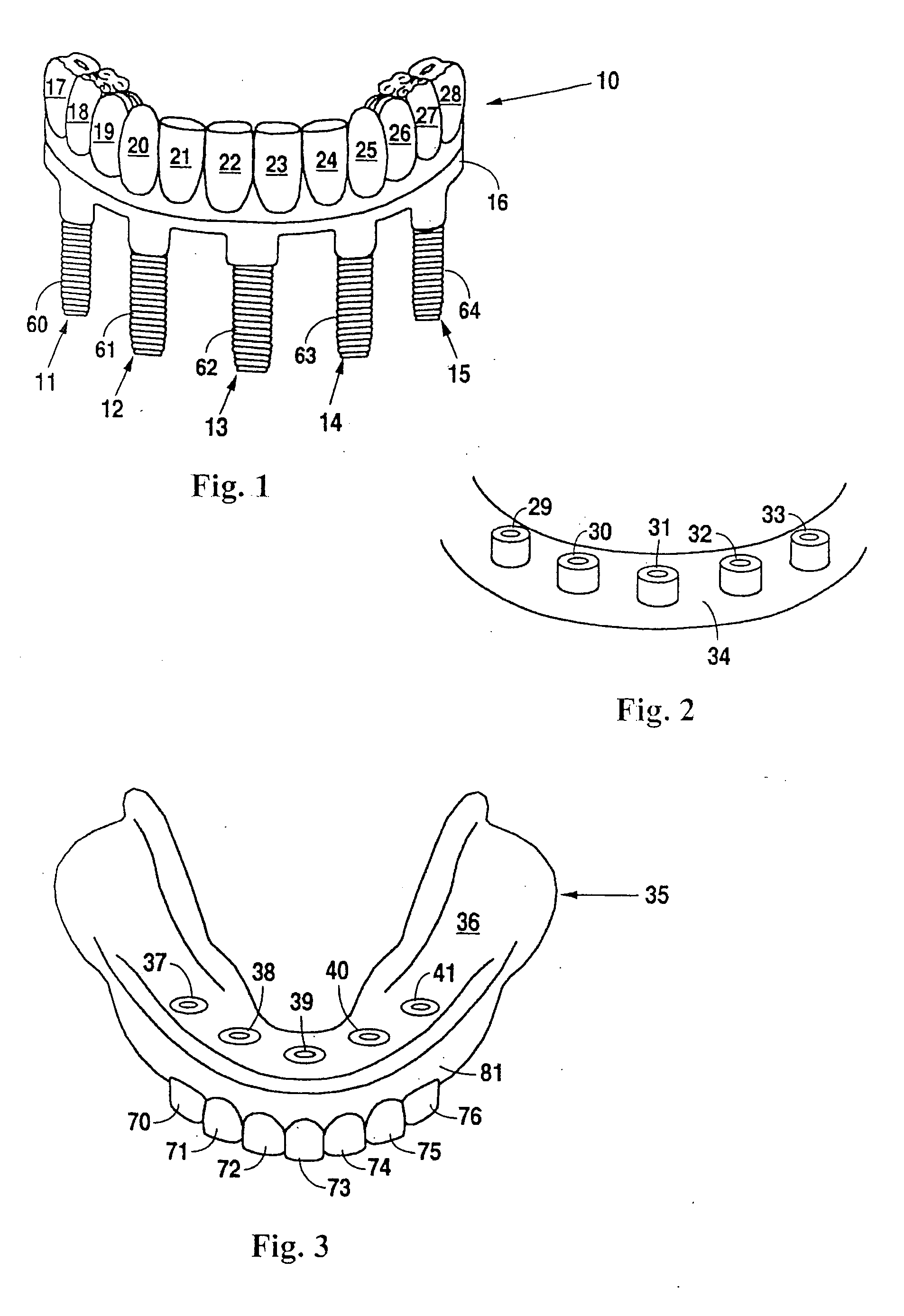 Design and manufacture of dental implant restorations