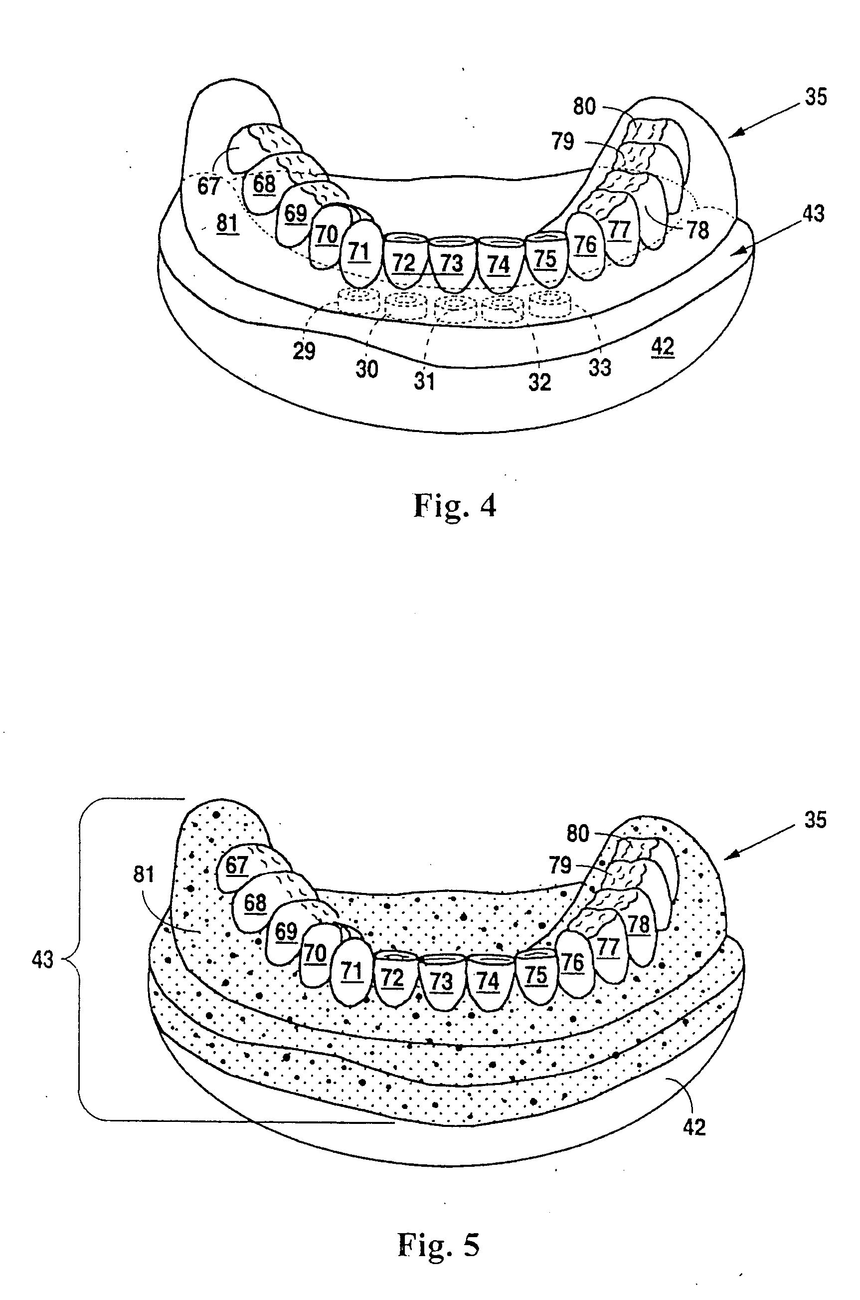 Design and manufacture of dental implant restorations