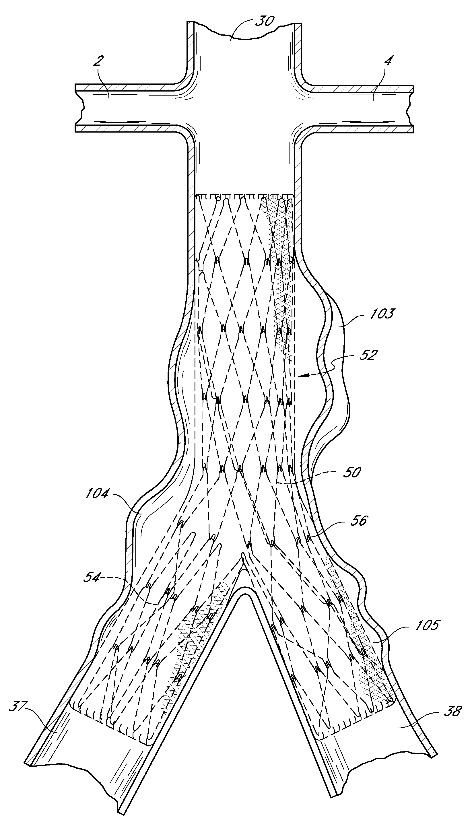 Bifurcated graft deployment systems and methods