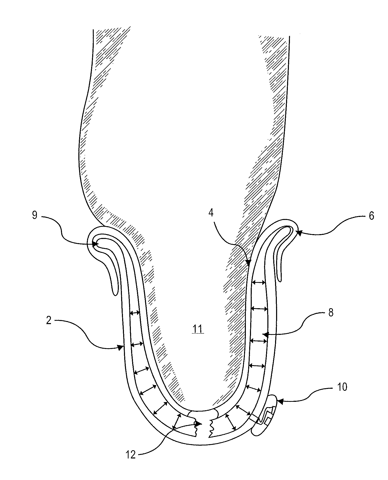 Adjustable prosthetic socket and suspension system