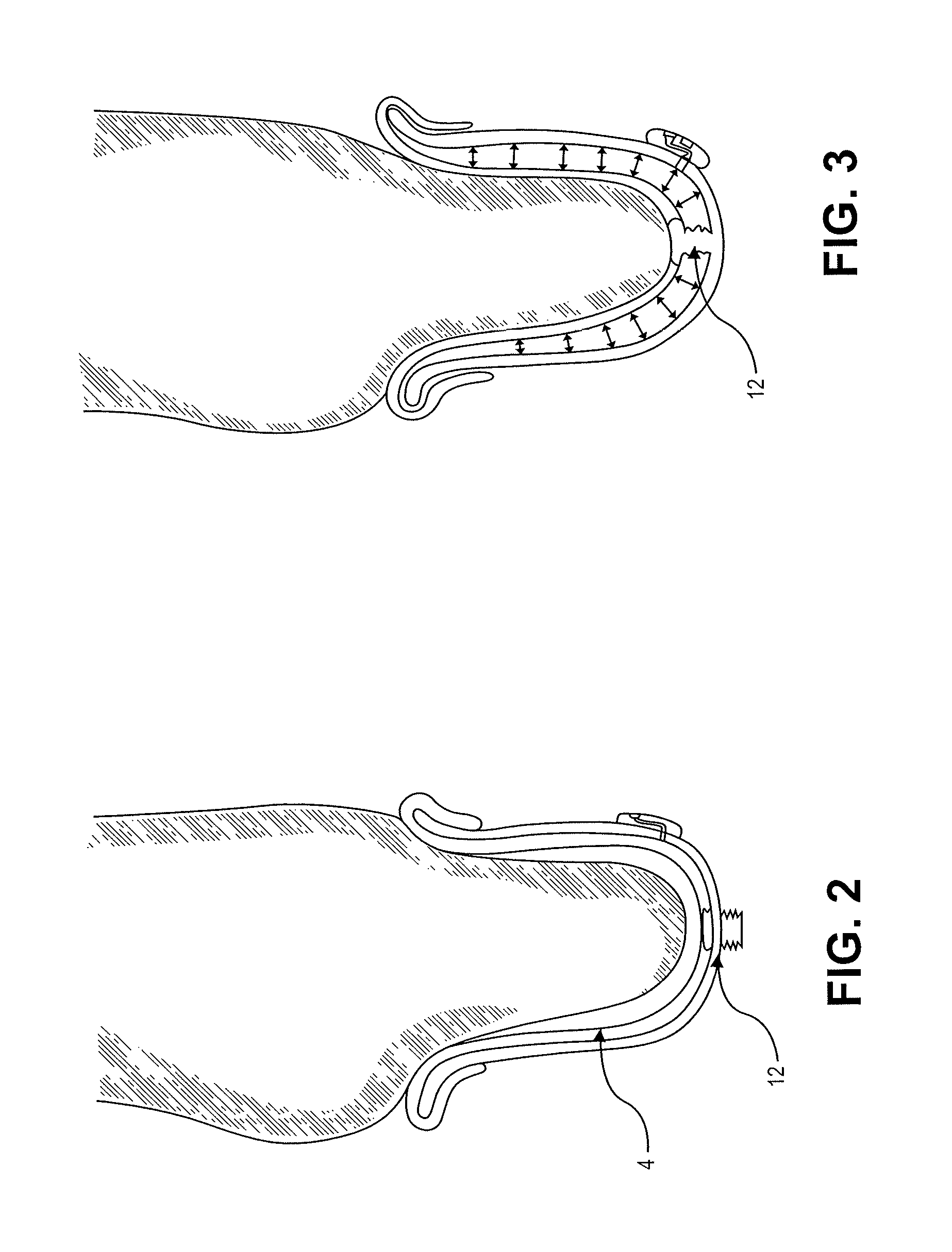 Adjustable prosthetic socket and suspension system