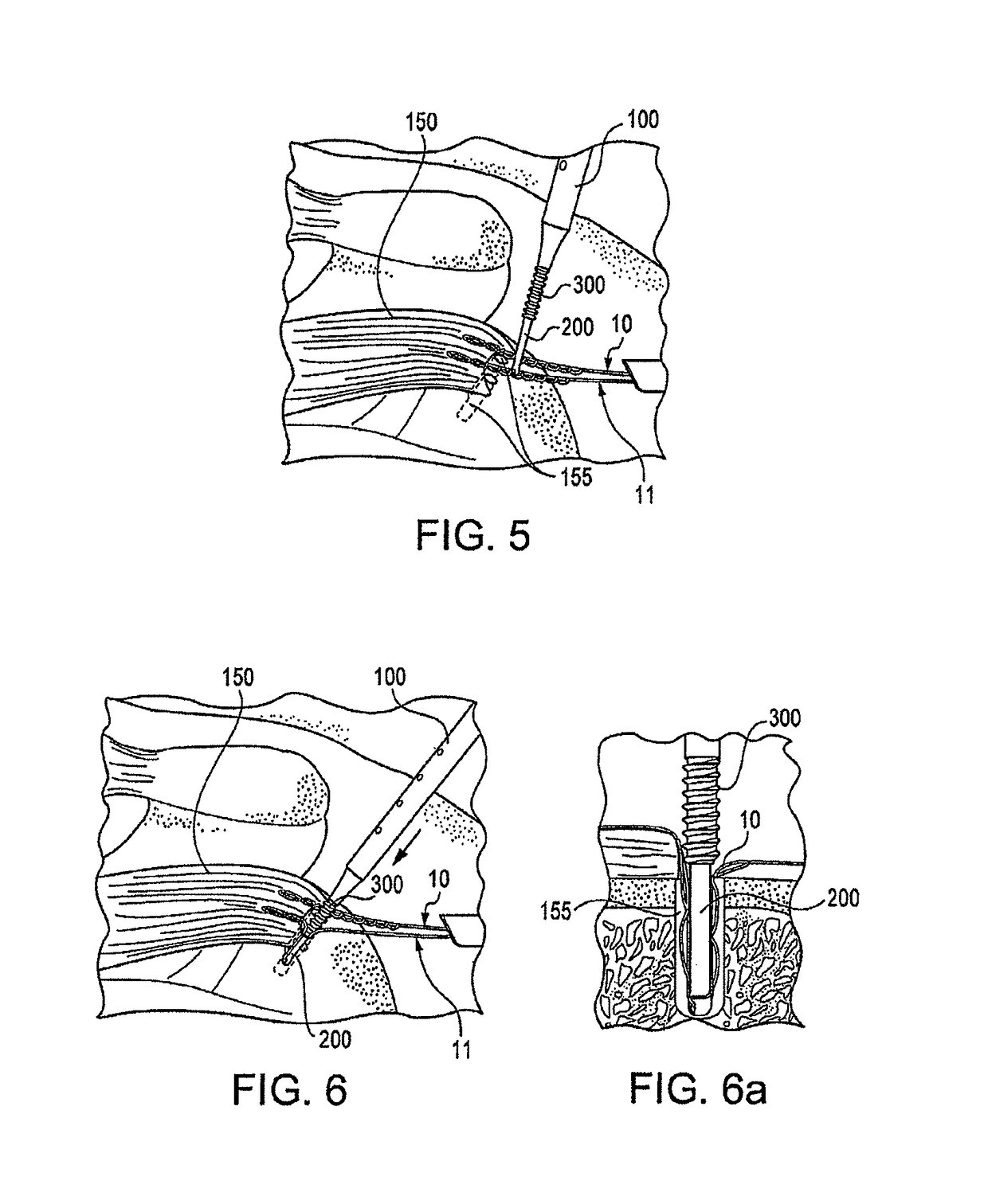 Method for knotless fixation of tissue with swivel anchor