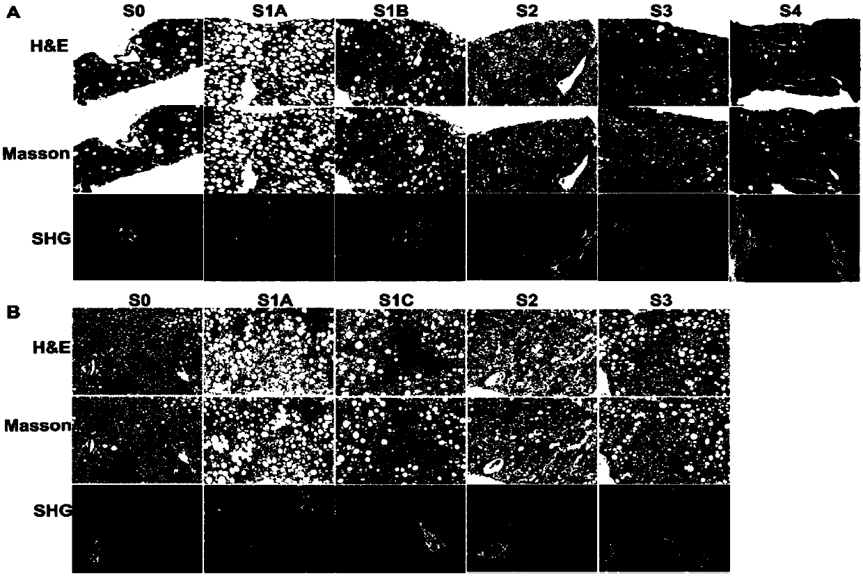 Application of parameters in SHG/TPEF images as hepatic fibrosis staging characteristic parameters of adults or children
