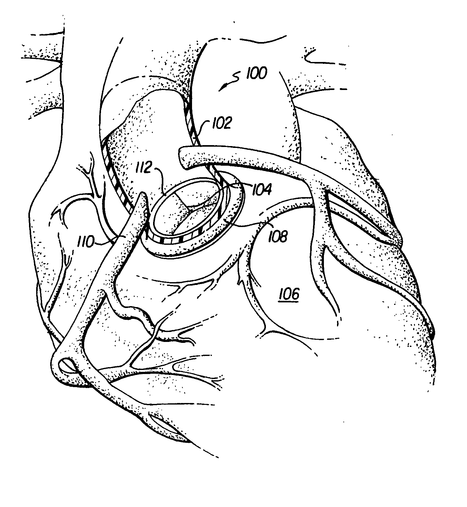Heart model for training or demonstrating heart valve replacement or repair