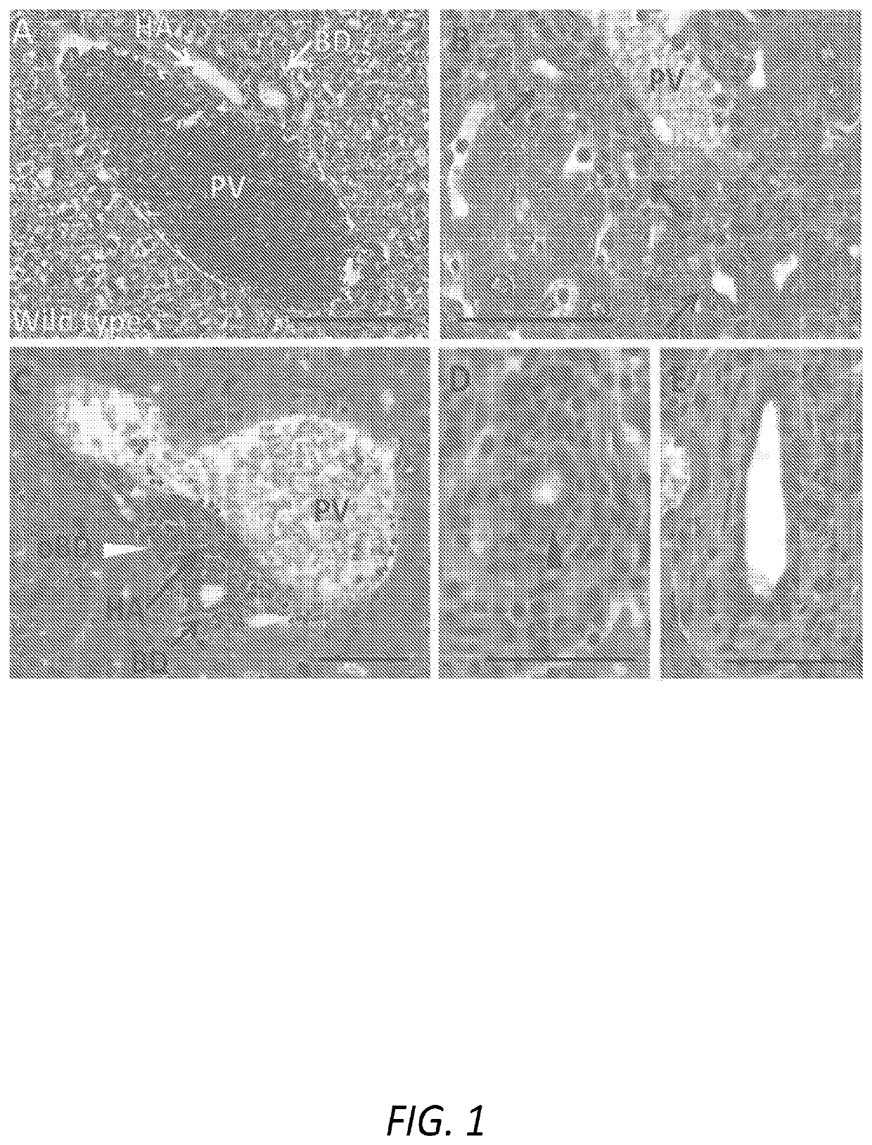 Use of sglt2 inhibitors to treat primary sclerosing cholangitis