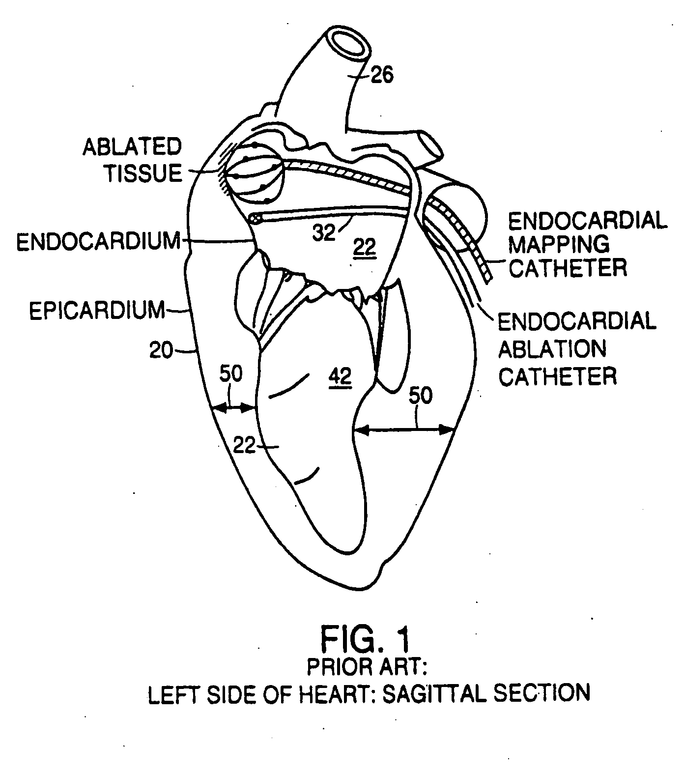 Cardiac ablation system and method for treatment of cardiac arrhthmias and transmyocardial revascularization