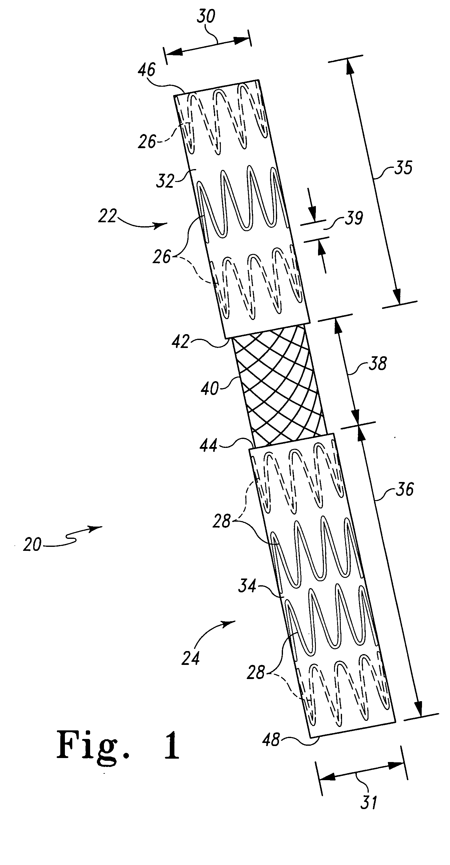 Interconnected leg extensions for an endoluminal prosthesis