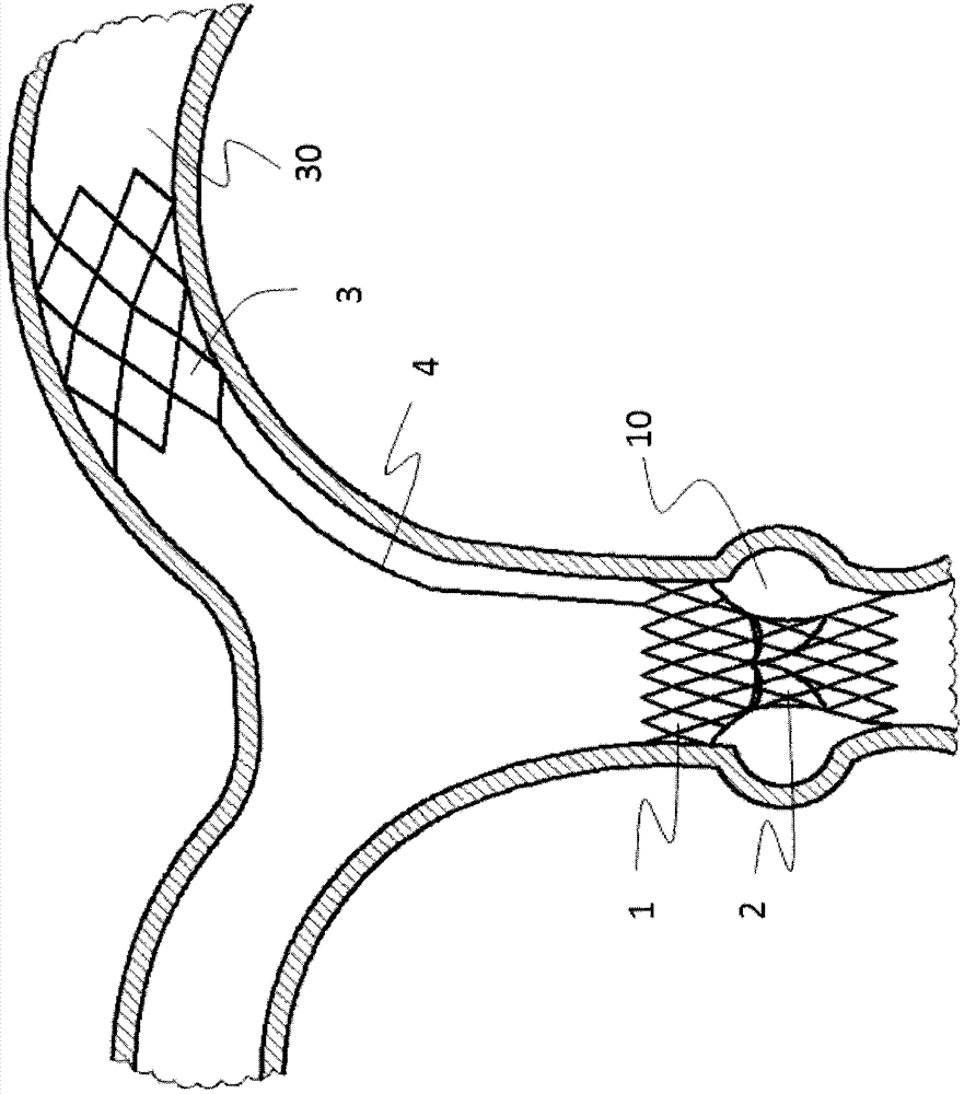 Pulmonary valve stent with anchor mechanism
