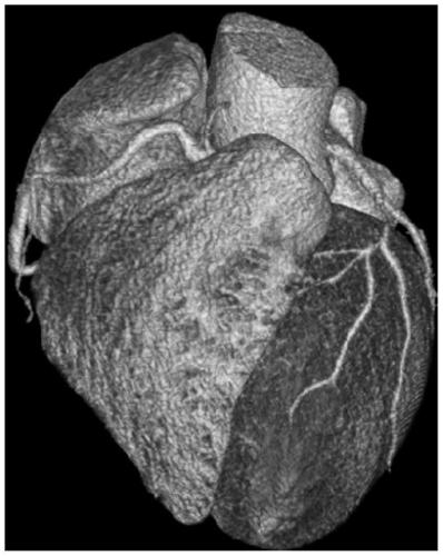Virtual coronary artery operation bypass analysis method and system, medium and equipment