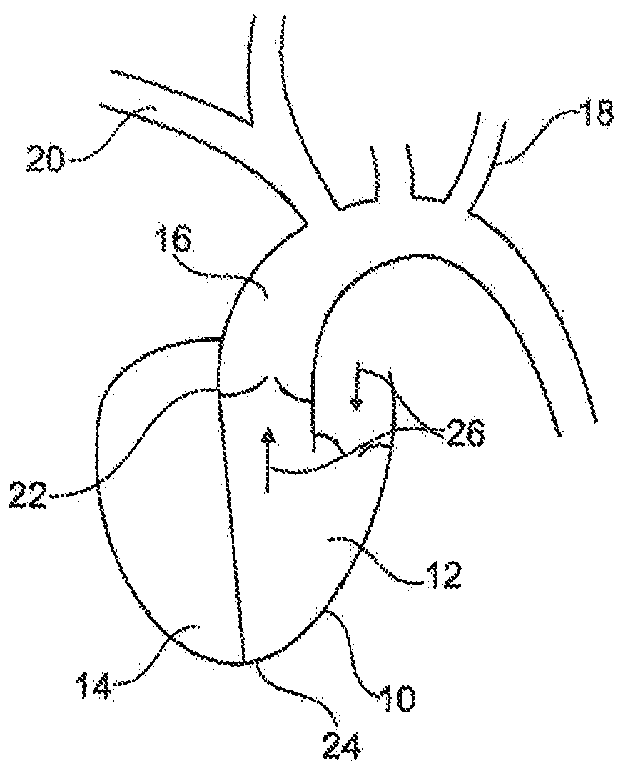 Aortic pump devices