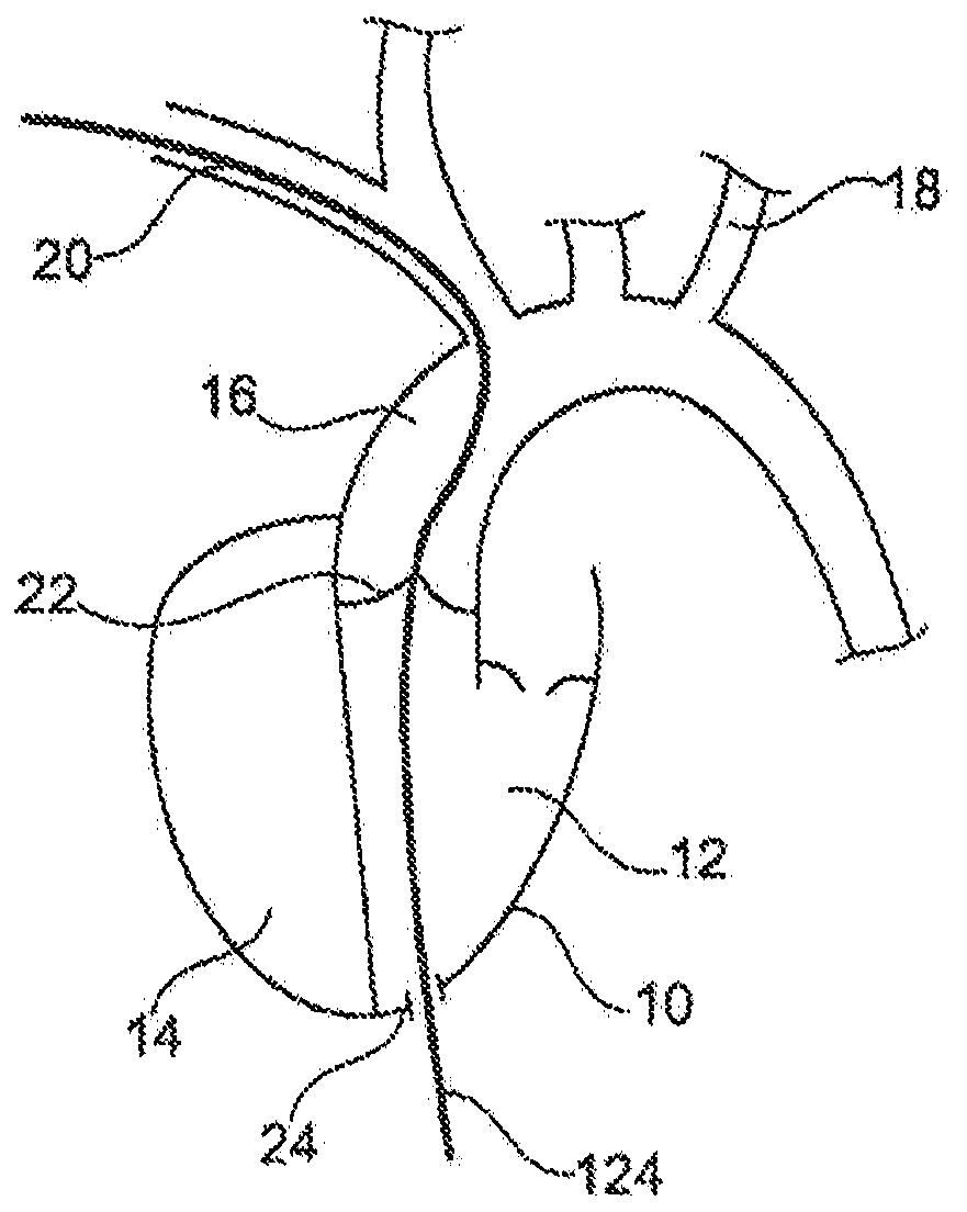 Aortic pump devices