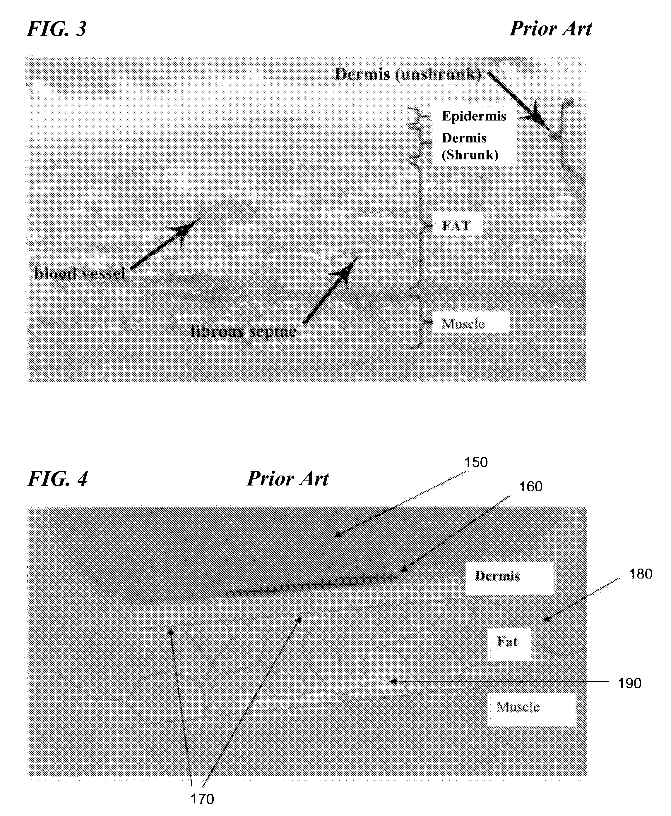 Acoustic applicators for controlled thermal modification of tissue