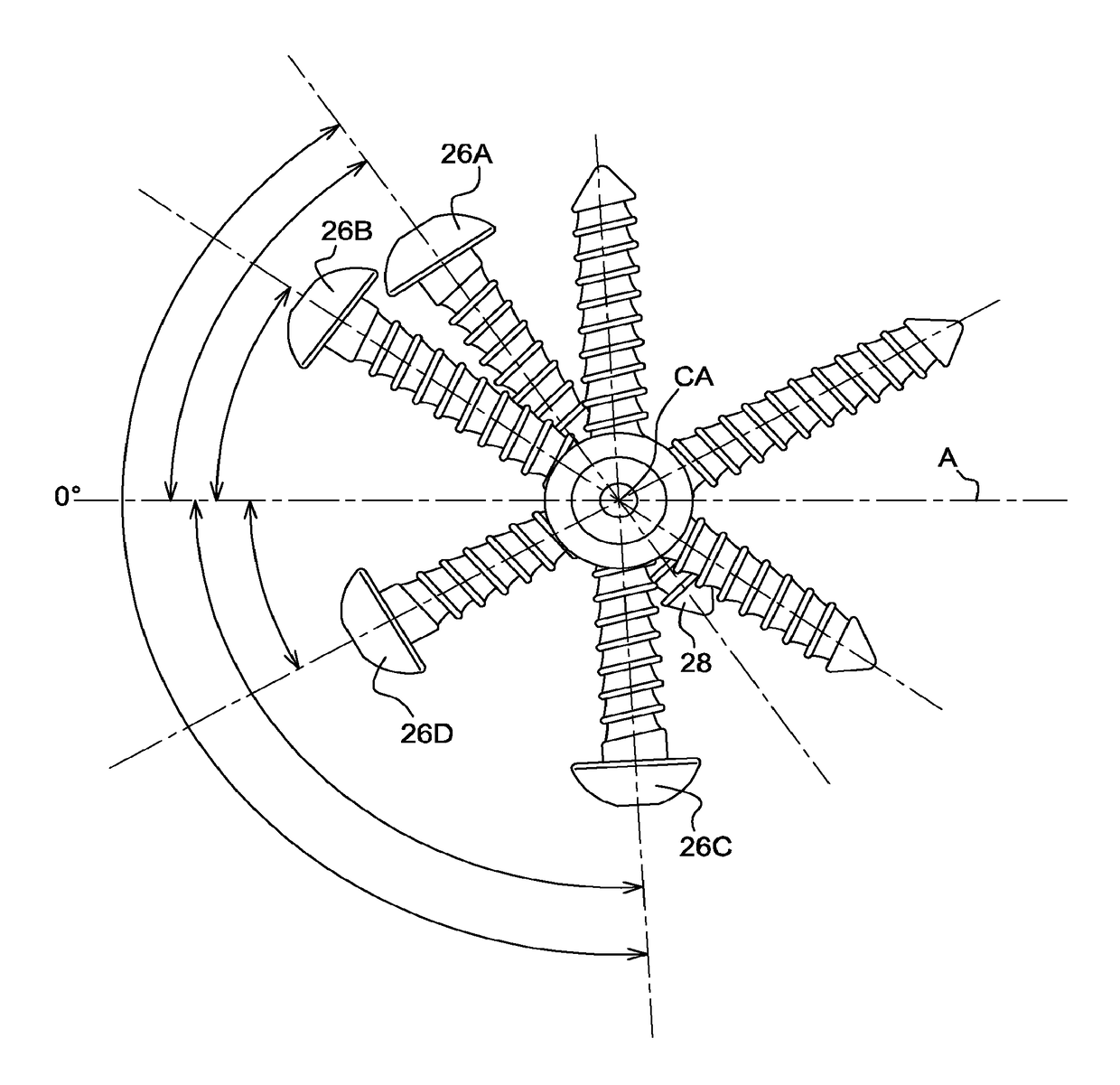 Surgical technique and apparatus for proximal humeral fracture repair