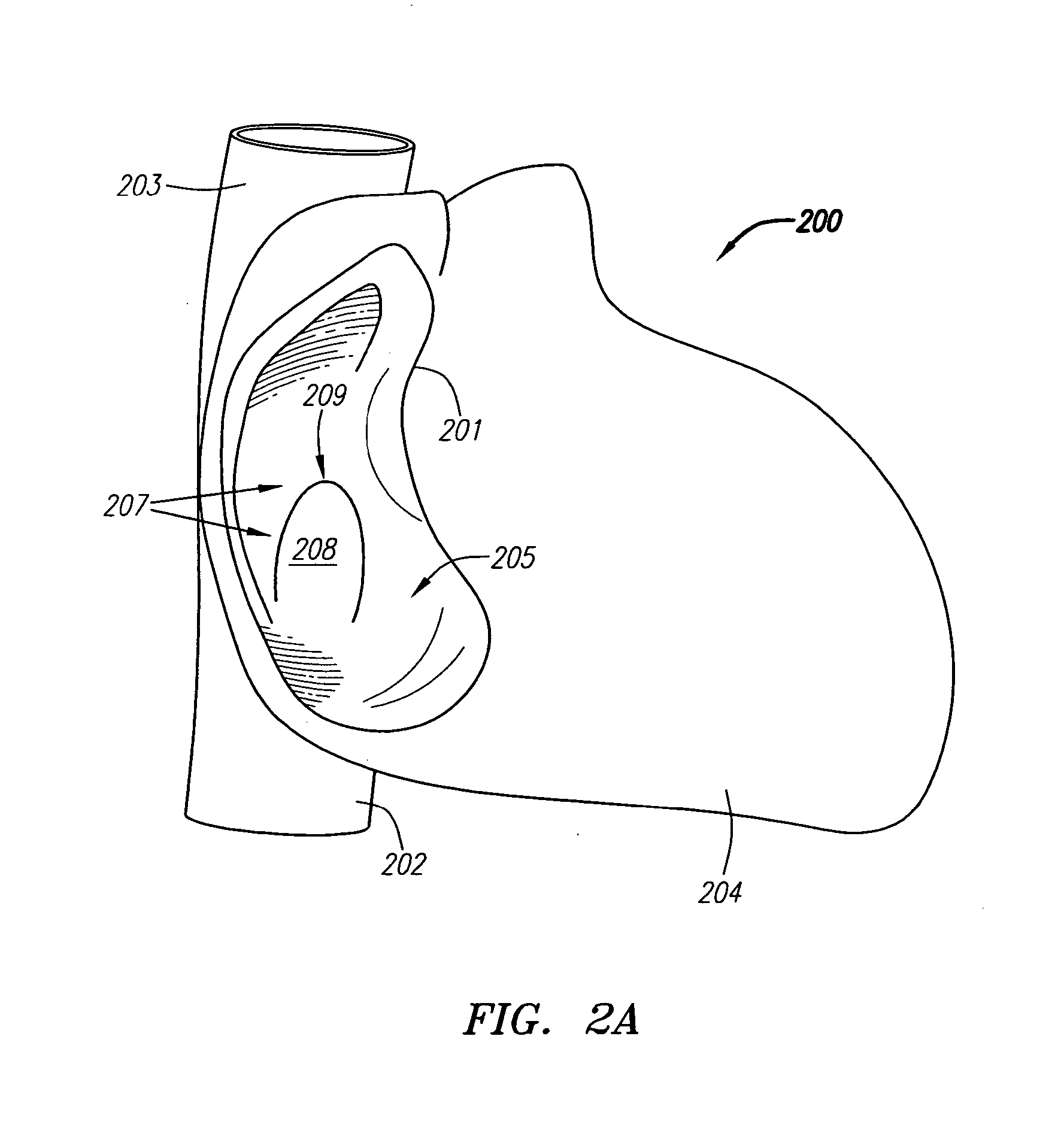 Suture-based systems and methods for treating septal defects