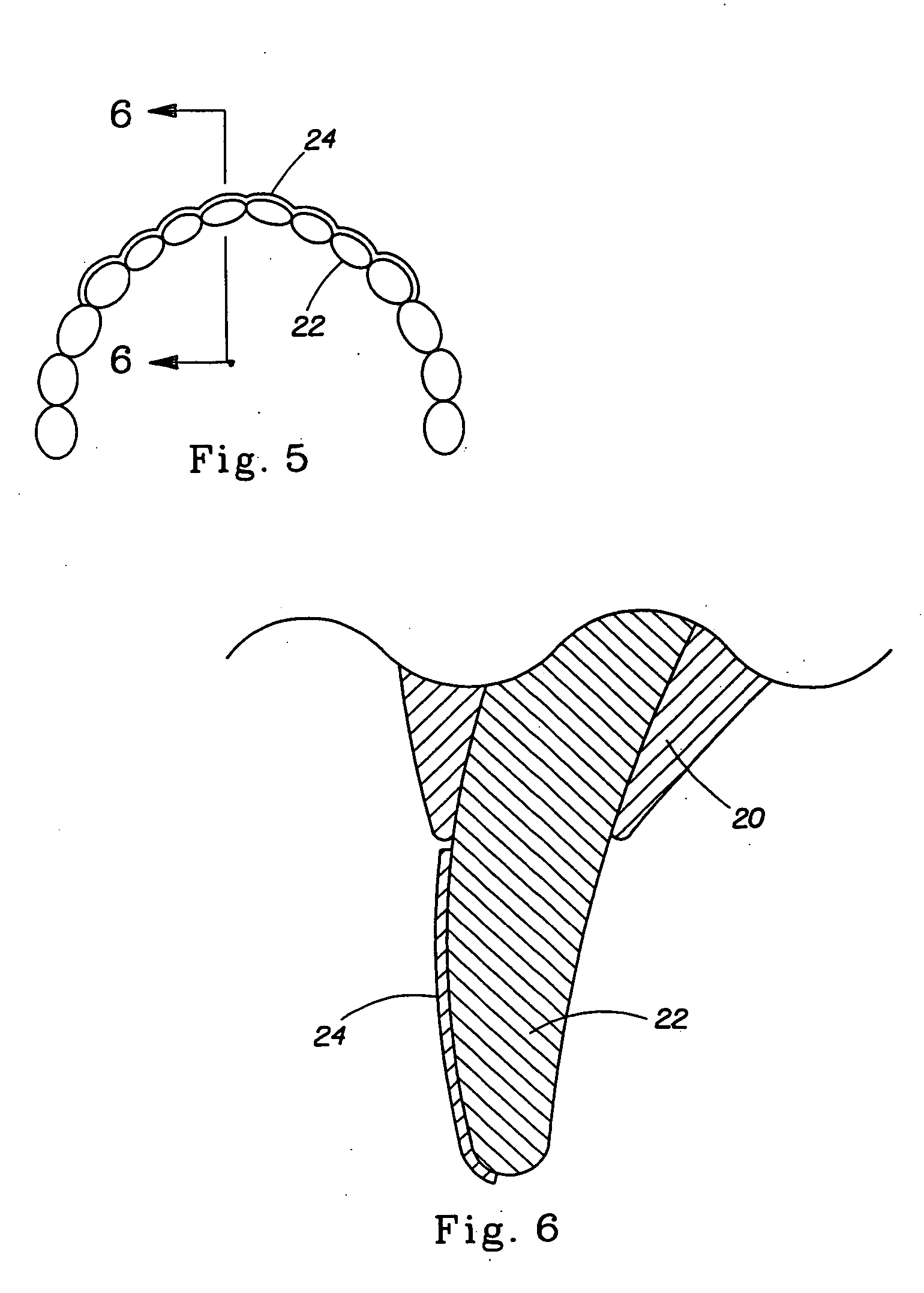 Dye composition and method for detection of demineralized lesions in teeth