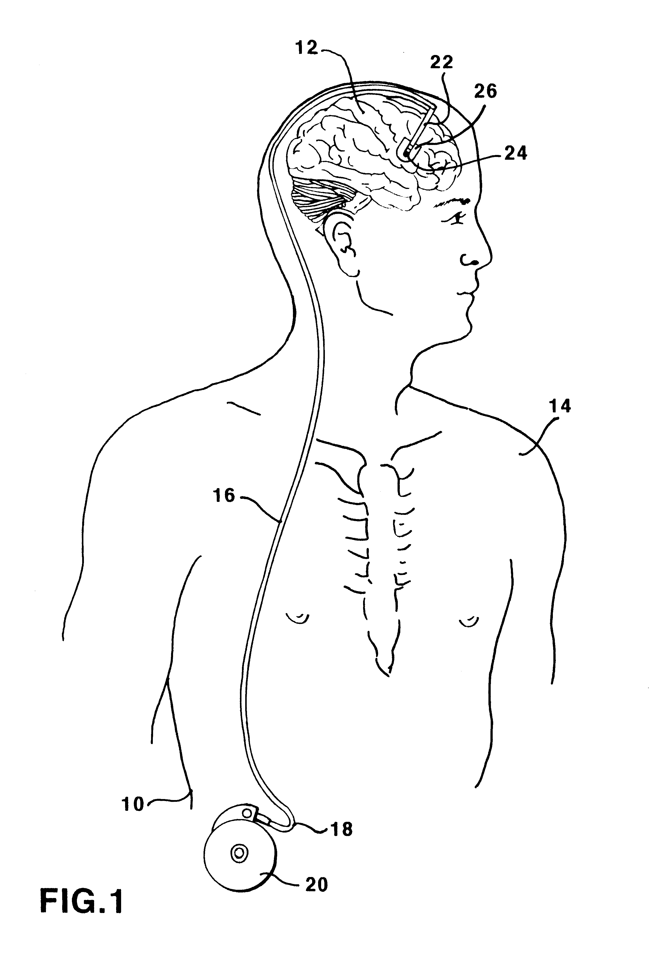 Method for manufacturing a catheter
