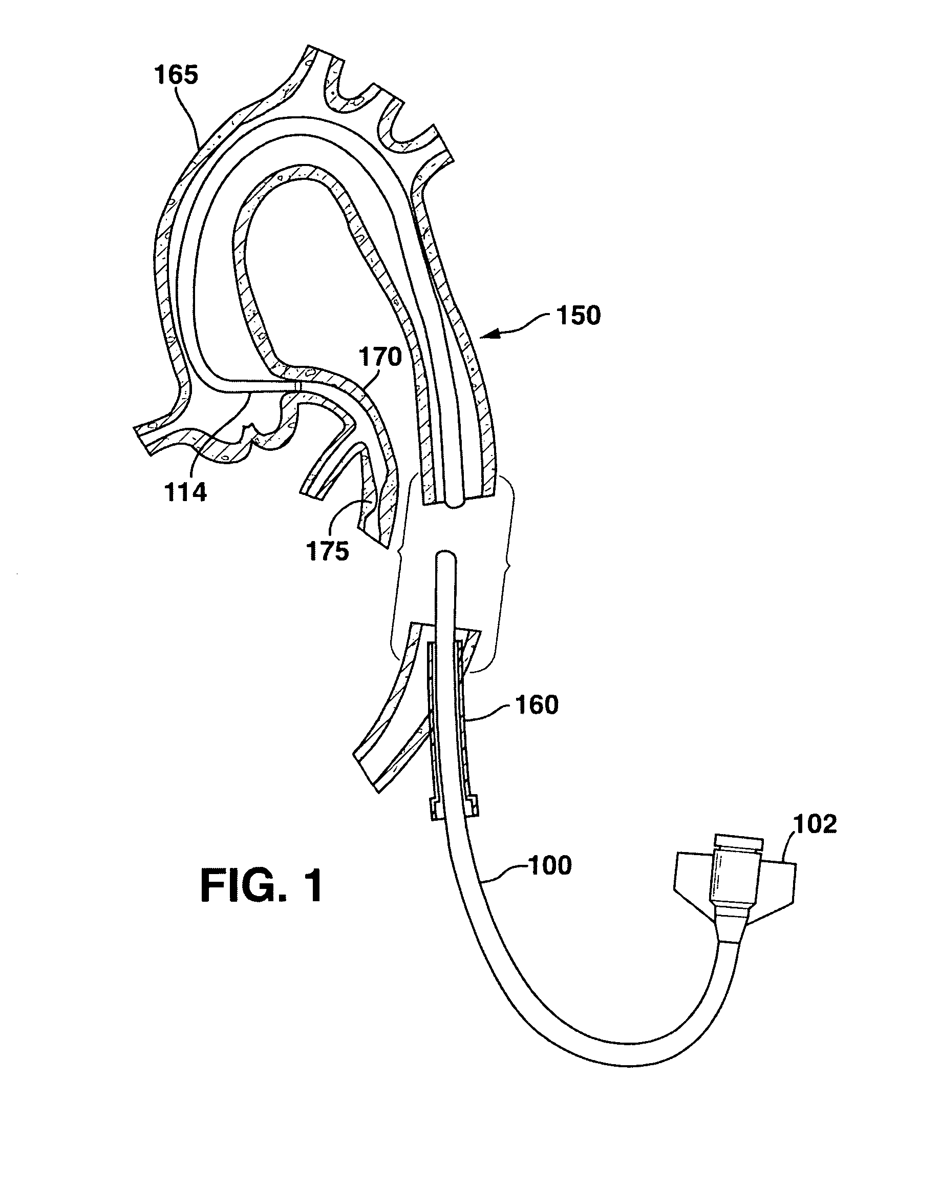 Composite laminated catheter with flexible segment and method of making same