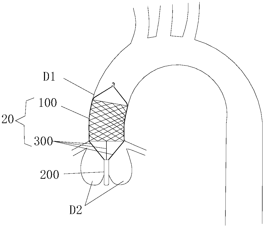 Auxiliary occlusion device used for aortic valve insufficiency