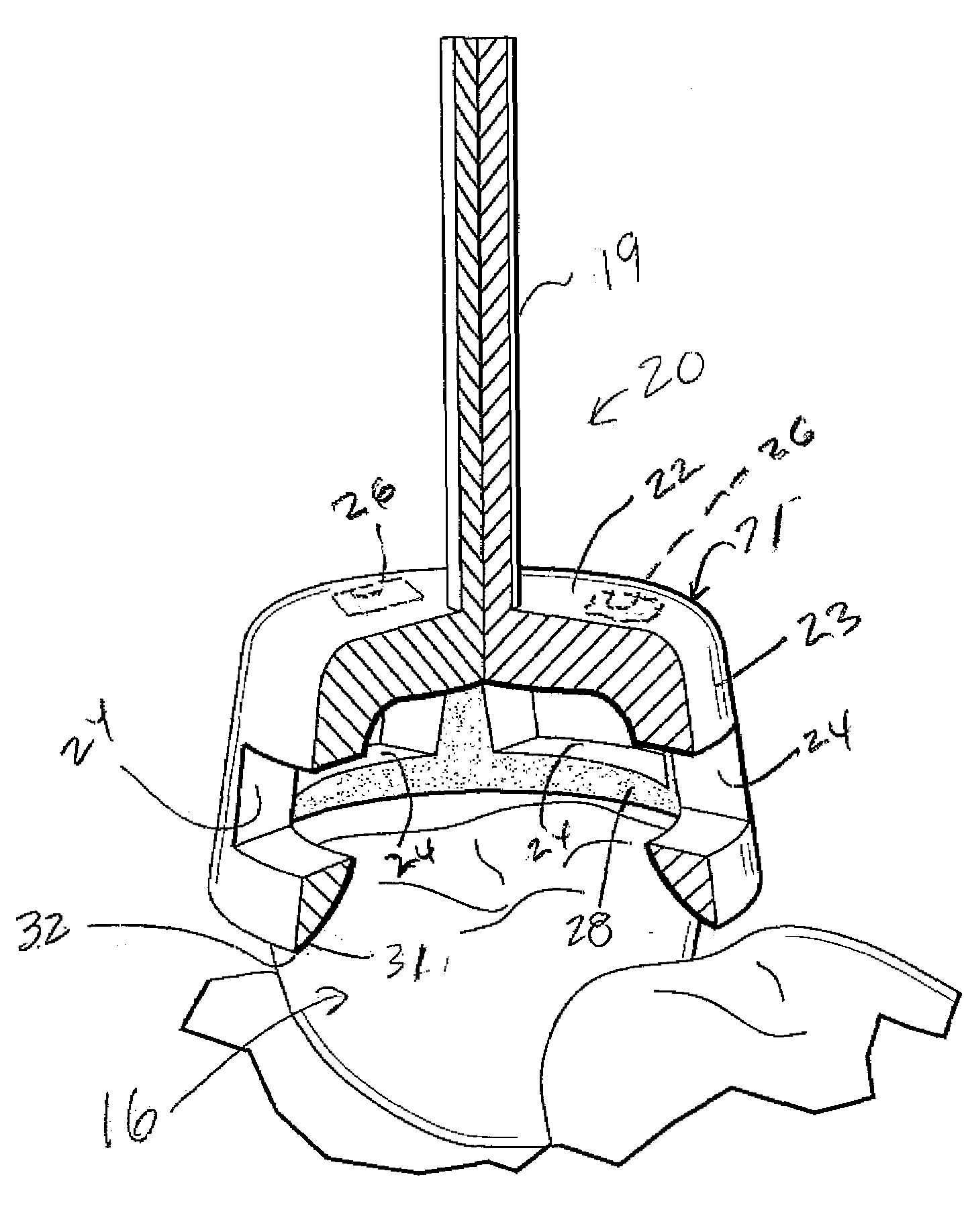 Truncated cone-shaped dental drill burr, measurement gauge and gingival cord applicator for dental crown preparation