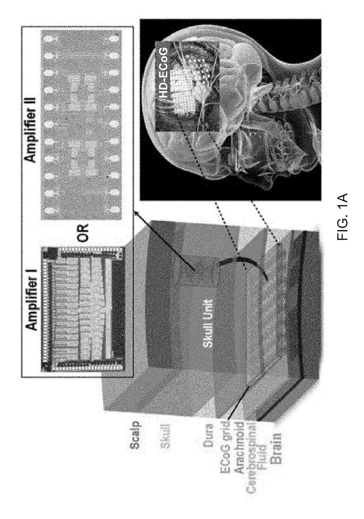 Implantable electrocorticogram brain-computer interface system for restoring extremity movement