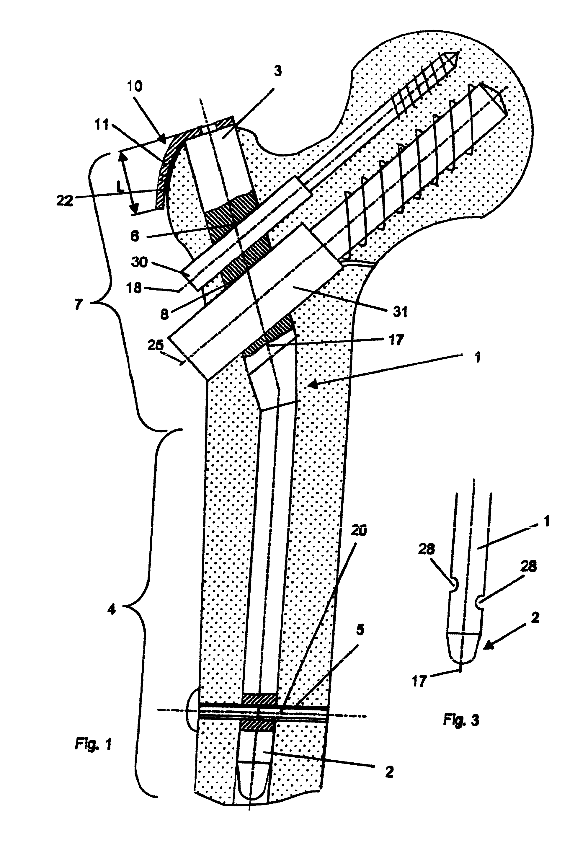Device for bone fixation
