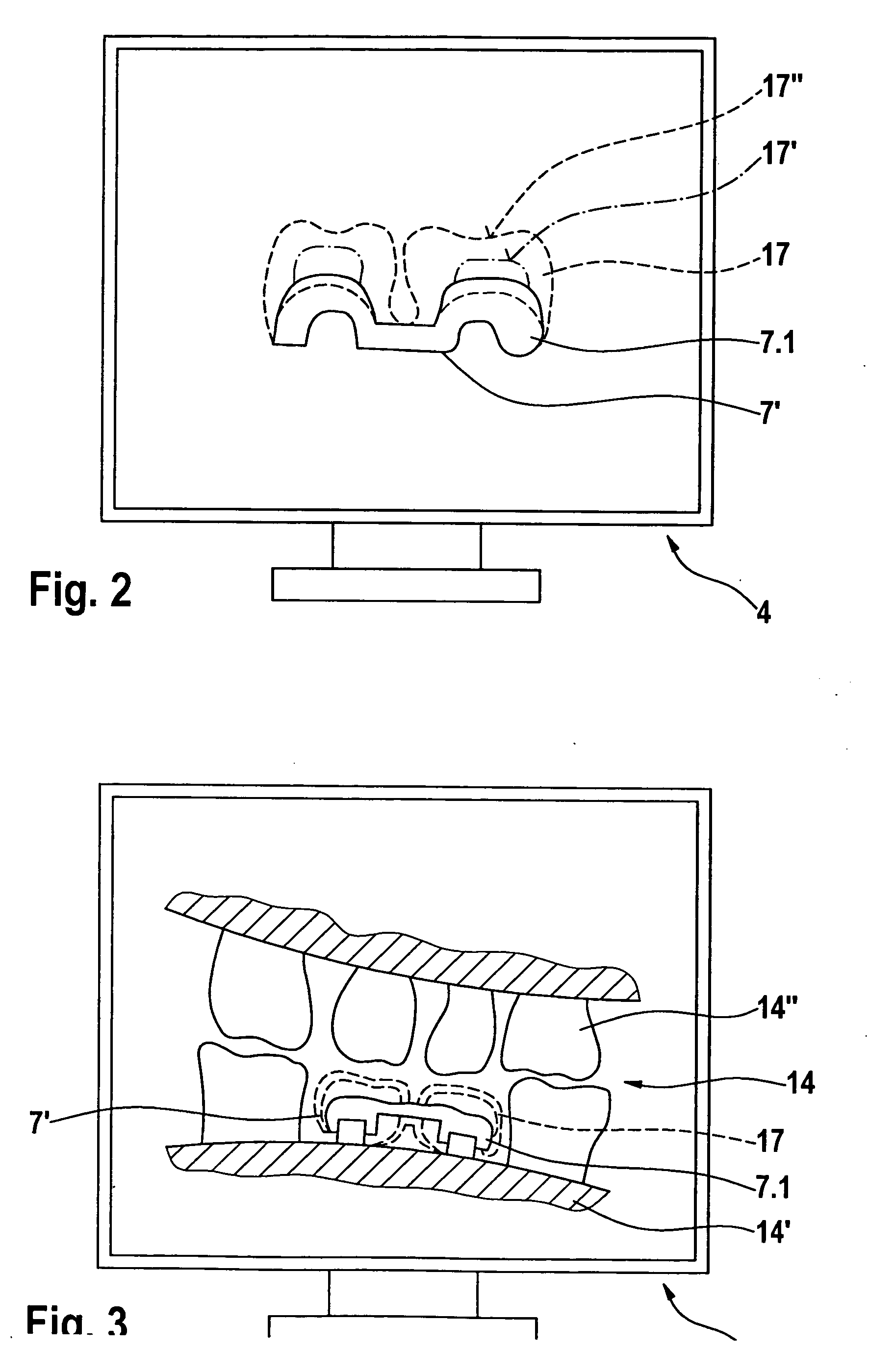 Method and Device for Producing Dental Prosthesis Elements