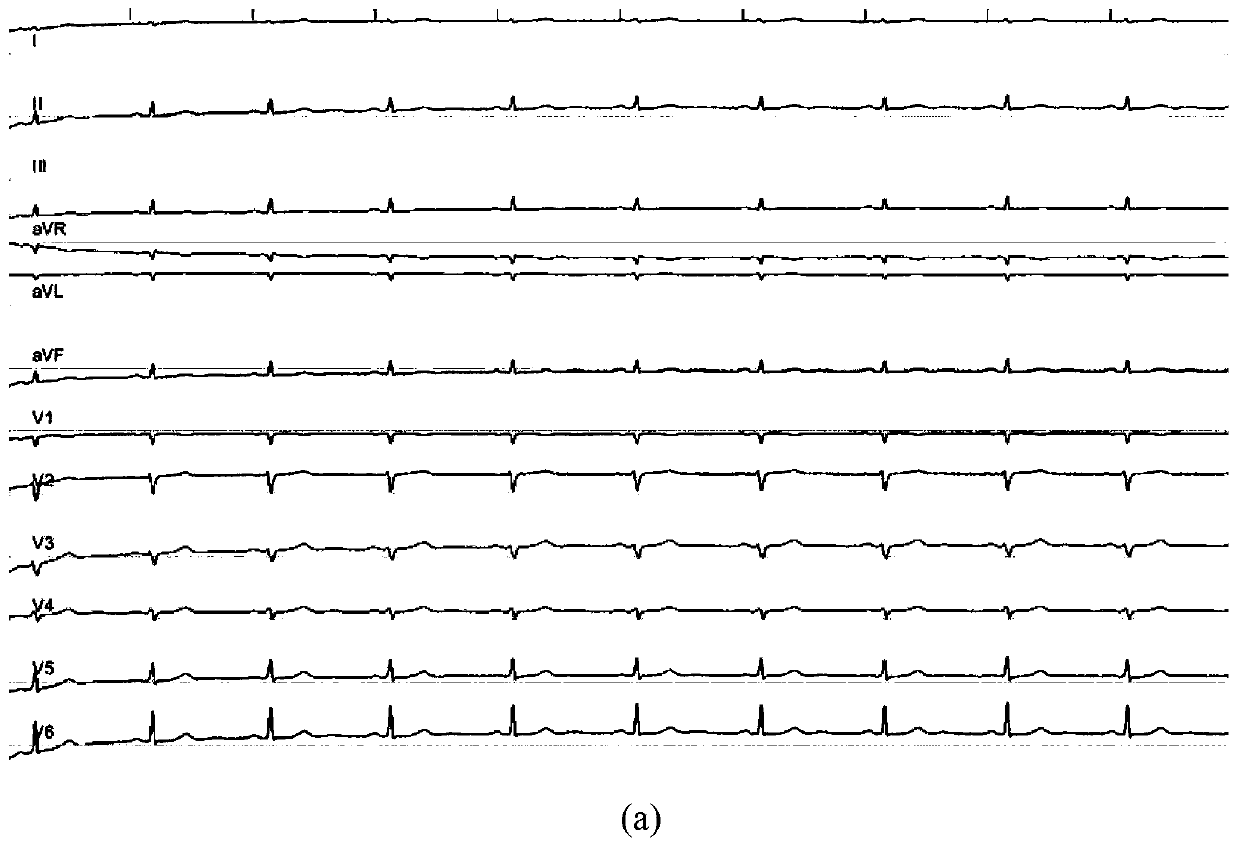 Method of detecting QRS complex start point in multi-lead electrocardiogram