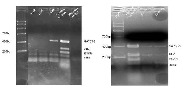 Kit for detecting free colorectal cancer cell markers in blood