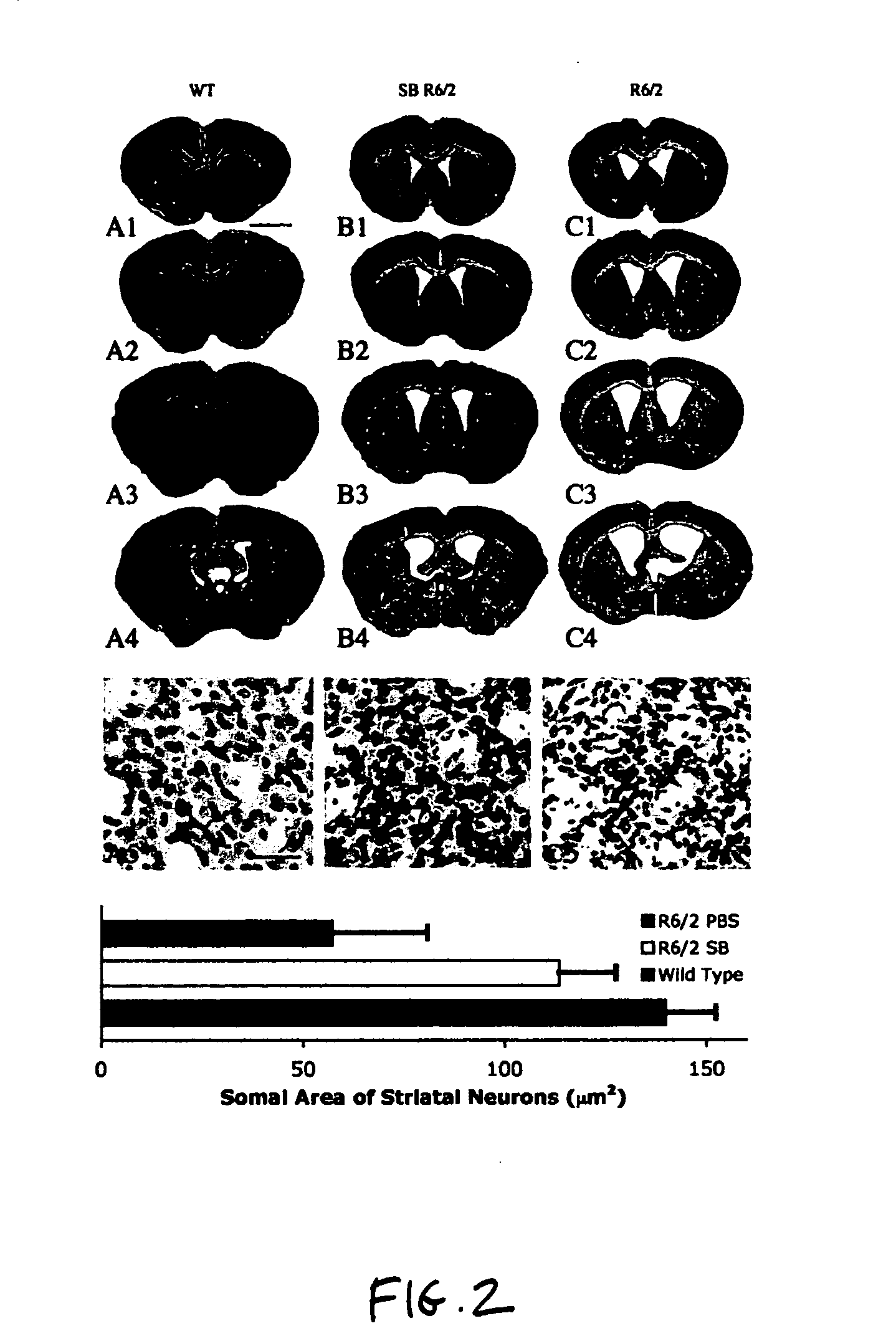Method of ameliorating or abrogating the effects of a neurodegenerative disorder, such as Huntington's disease, by sodium butyrate chemotherapy