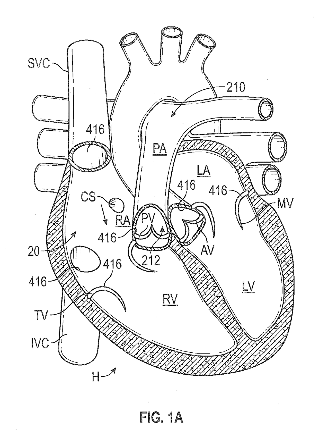 Devices and systems for docking a heart valve