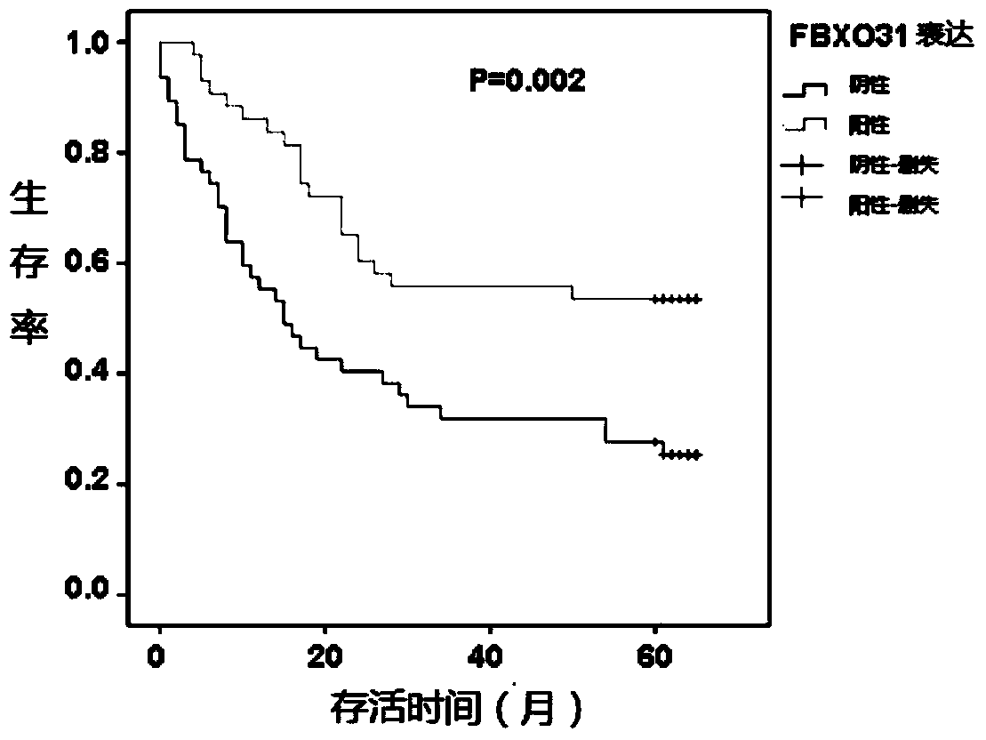 Application of FBXO31 gene and related products in preparing gastric cancer diagnostic reagent