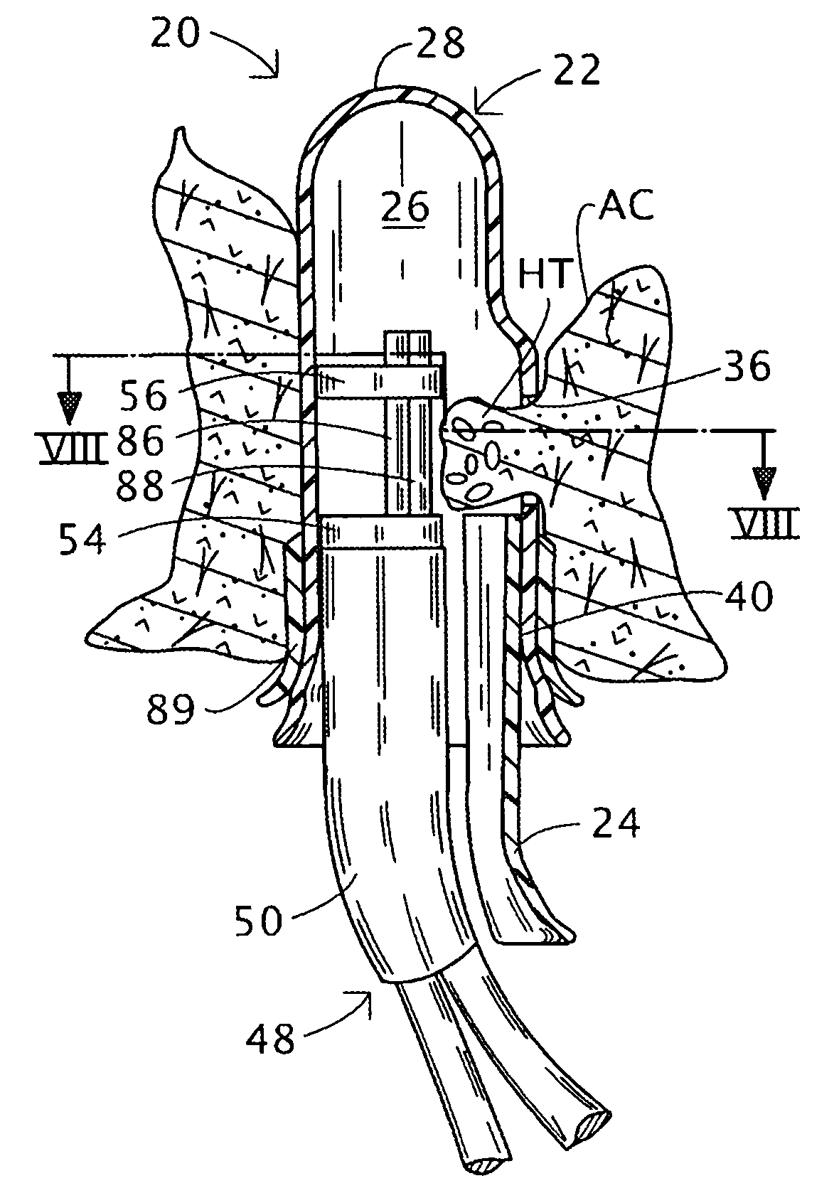 Hemorrhoids treatment method and associated instrument assembly including anoscope and cofunctioning tissue occlusion device