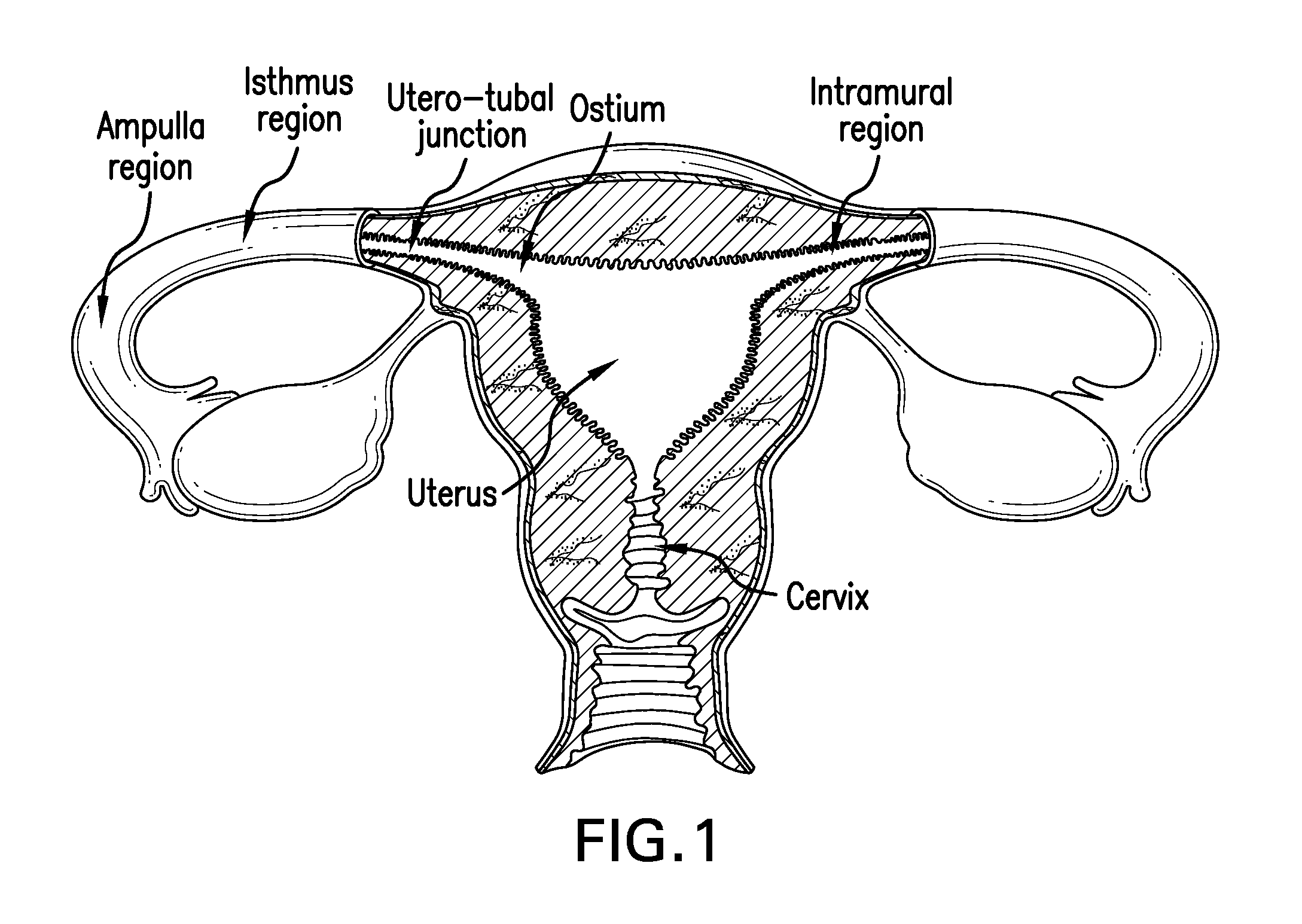 System and method for fallopian tube occlusion