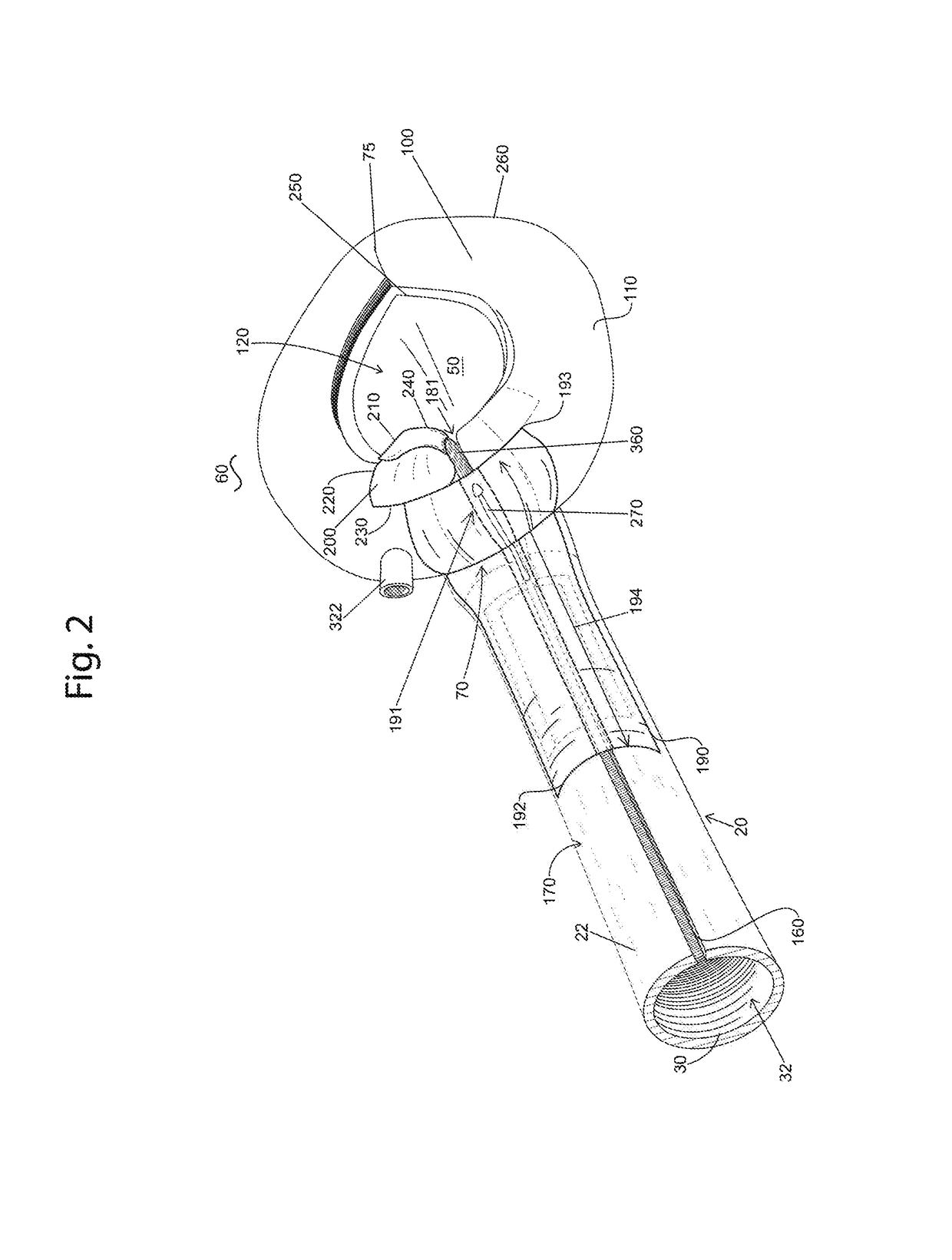 Easily removable intubating LMA