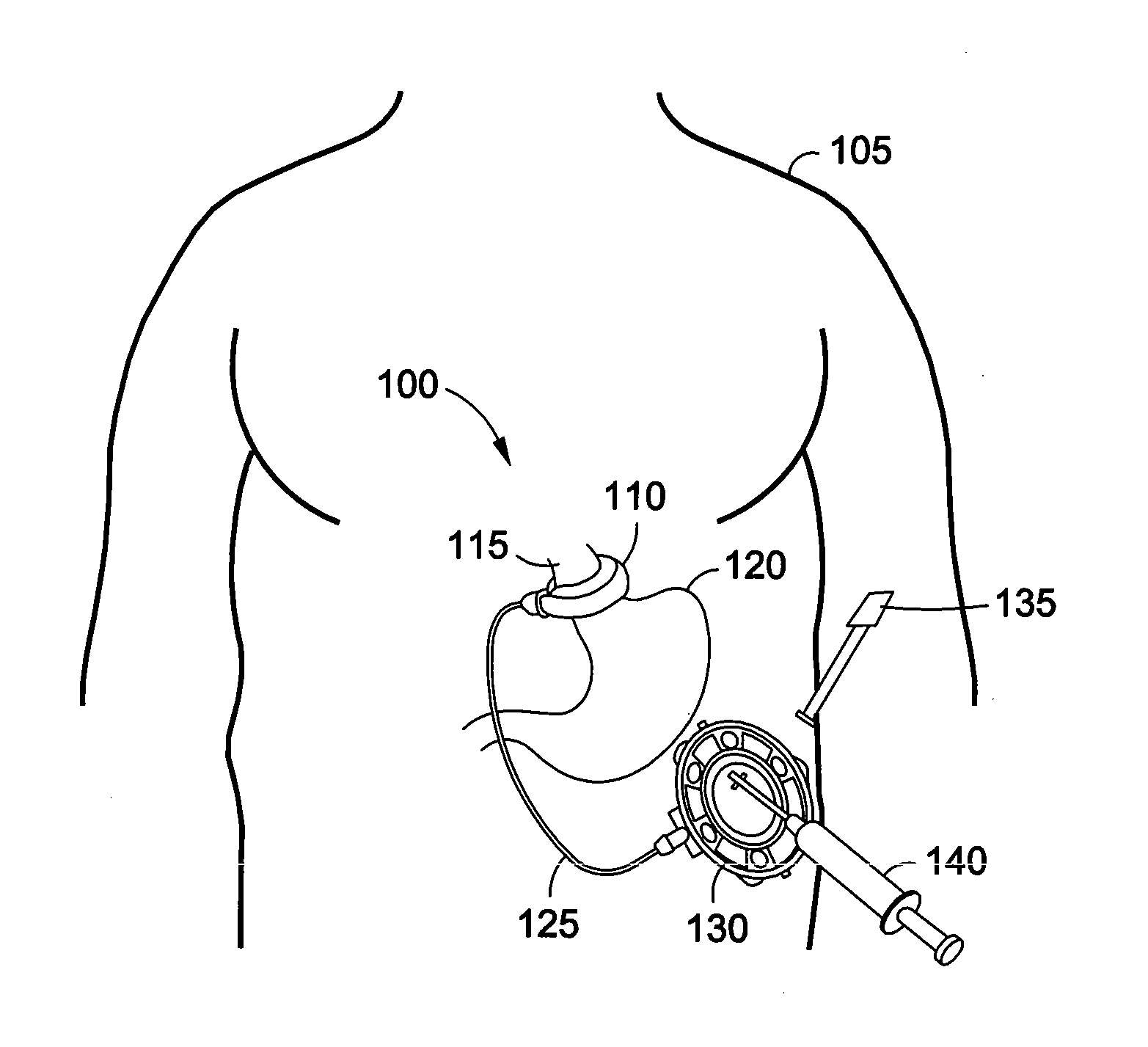 Implantable access port system