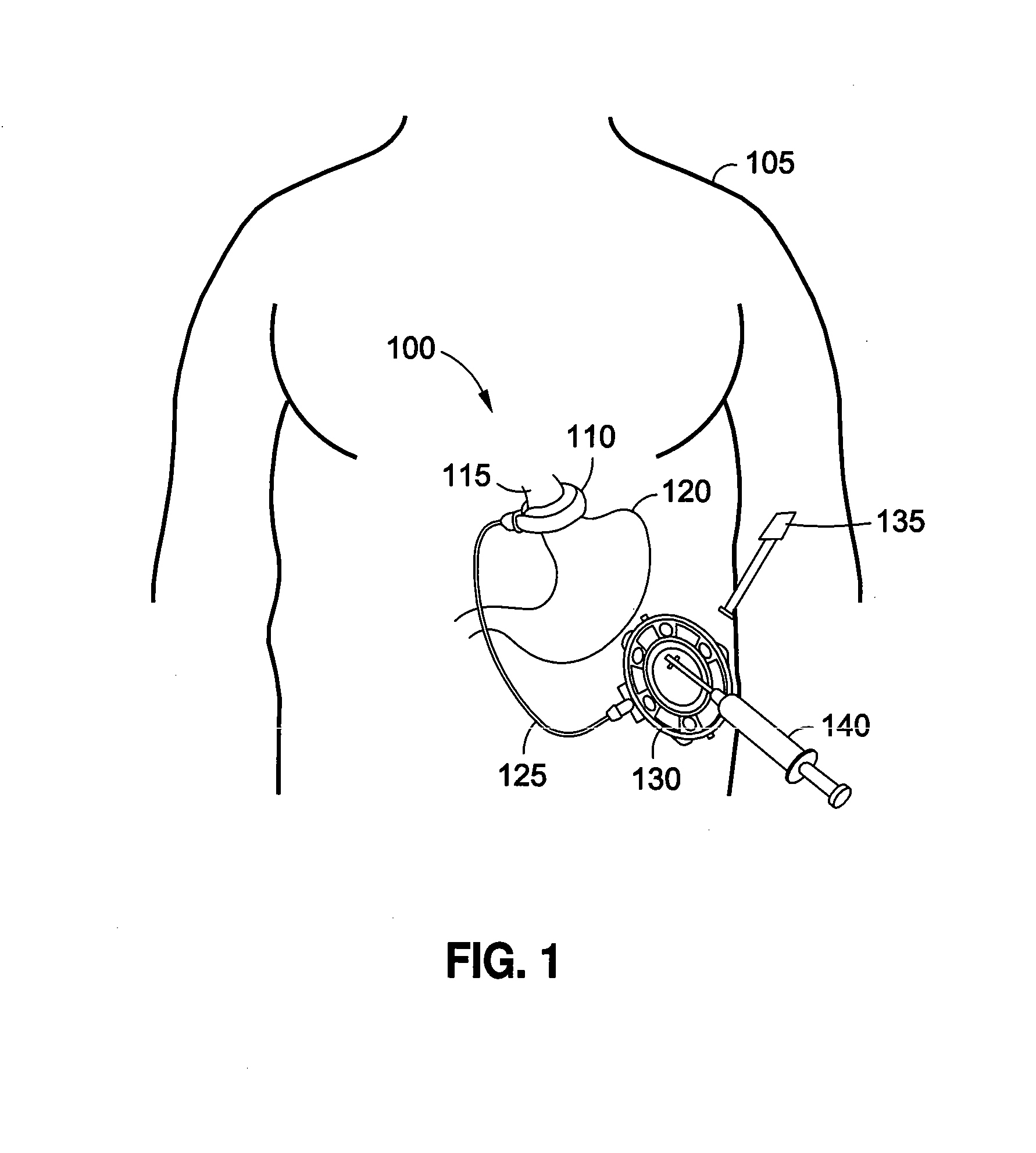 Implantable access port system