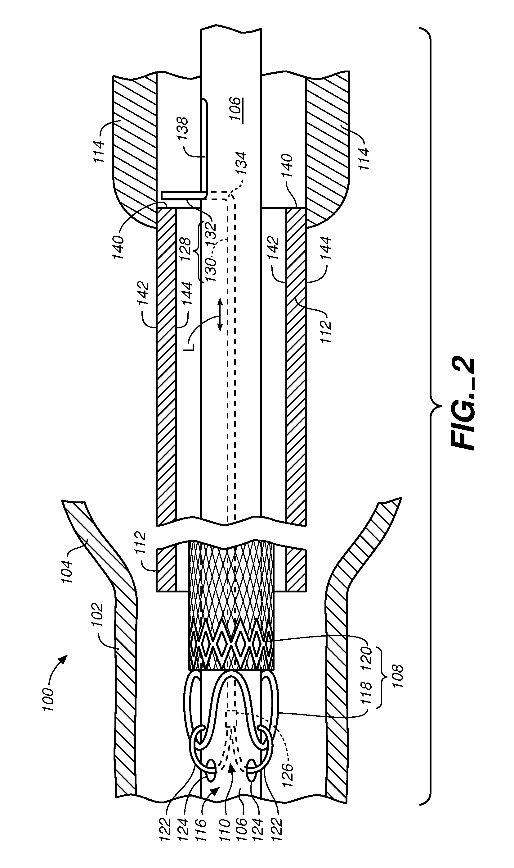Stent-Graft Delivery System